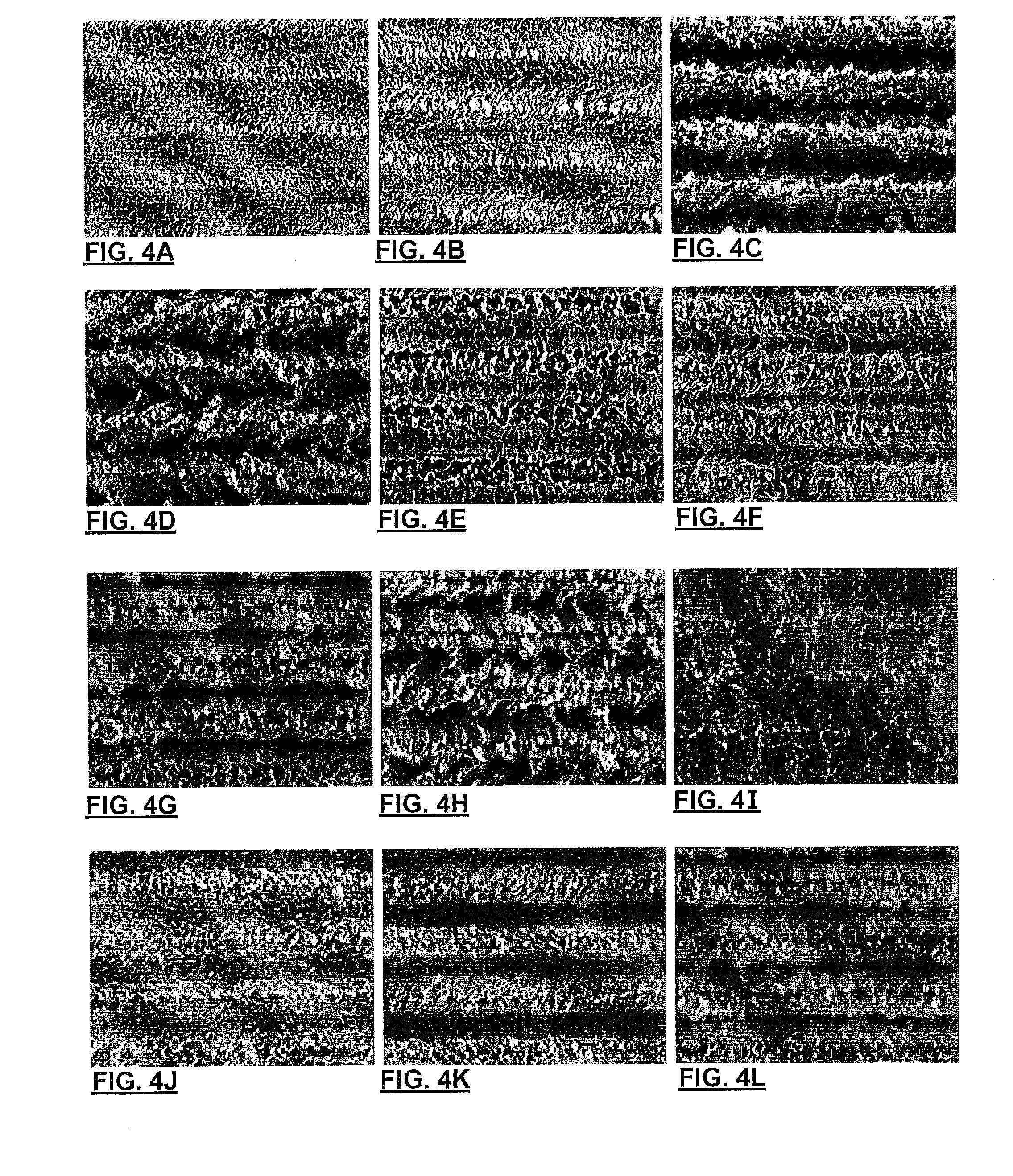 Metallic surface with karstified relief, forming same, and high surface area metallic electrochemical interface