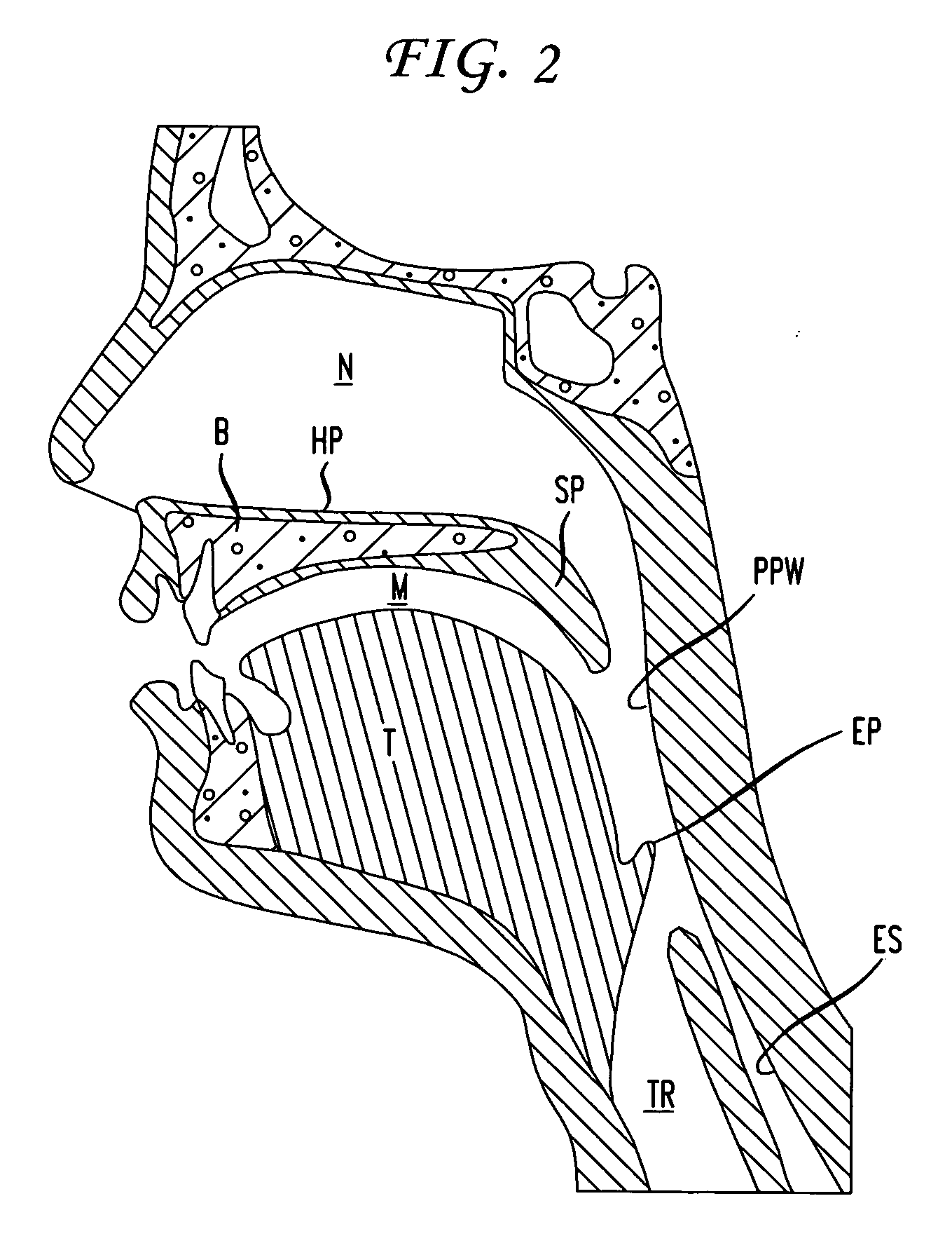 Magnetic implants and methods for treating an oropharyngeal condition