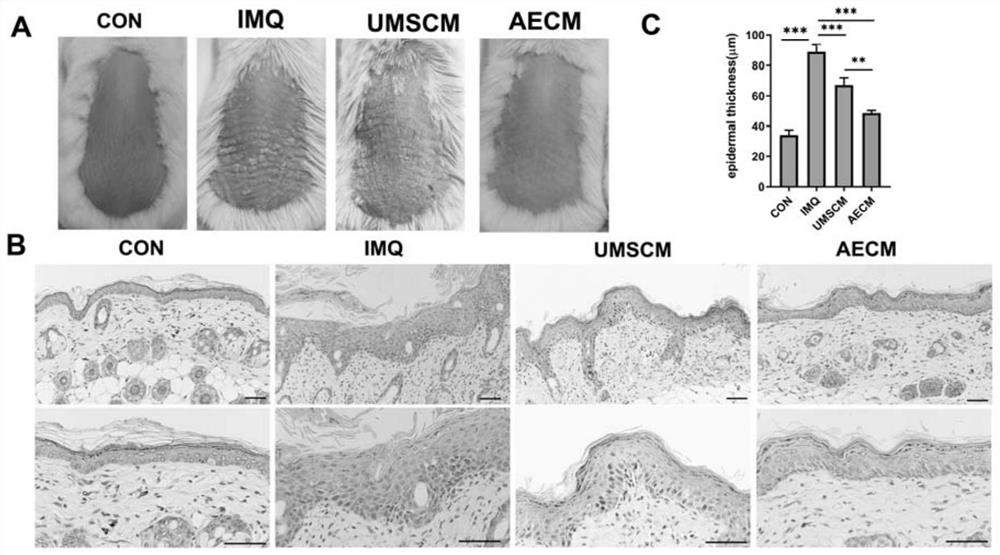 Application of stem cell conditioned medium in preparation of medicine for treating inflammatory skin