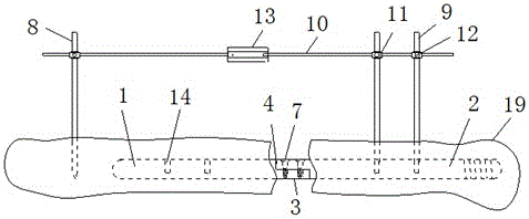 A minimally invasive intramedullary fixation device for clavicle fractures