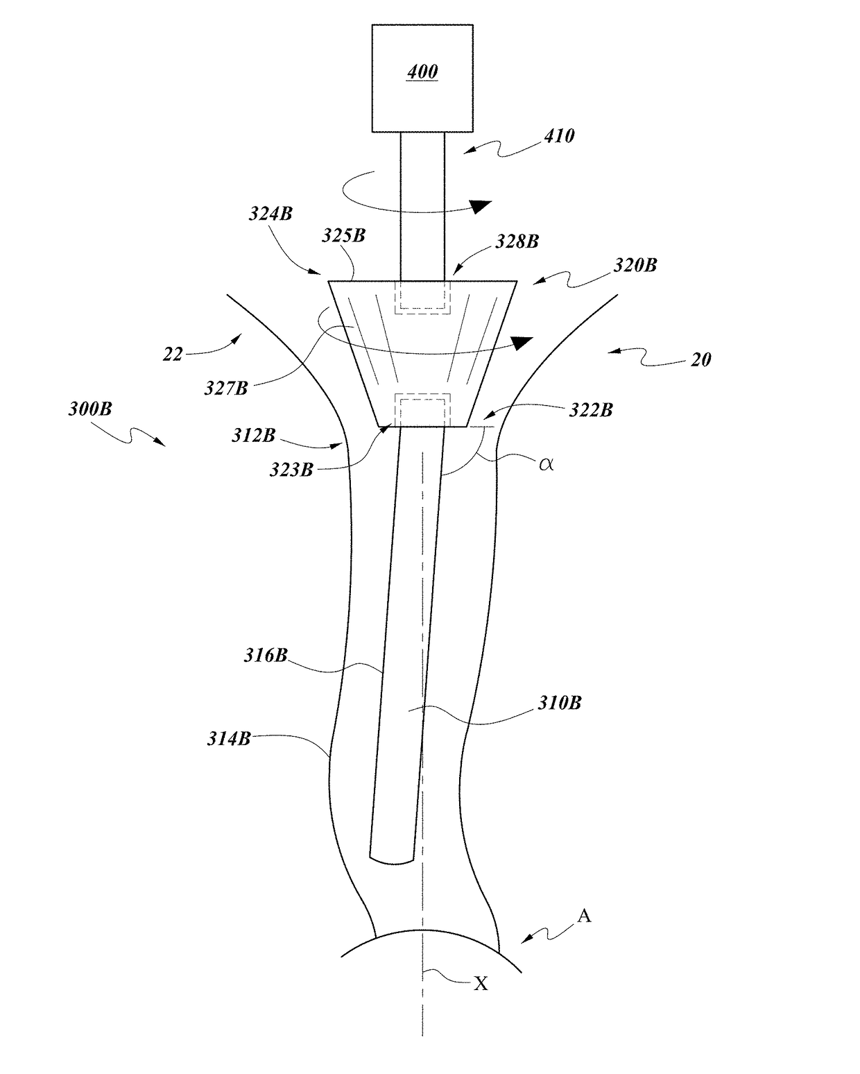 Modular total knee arthroplasty system and method