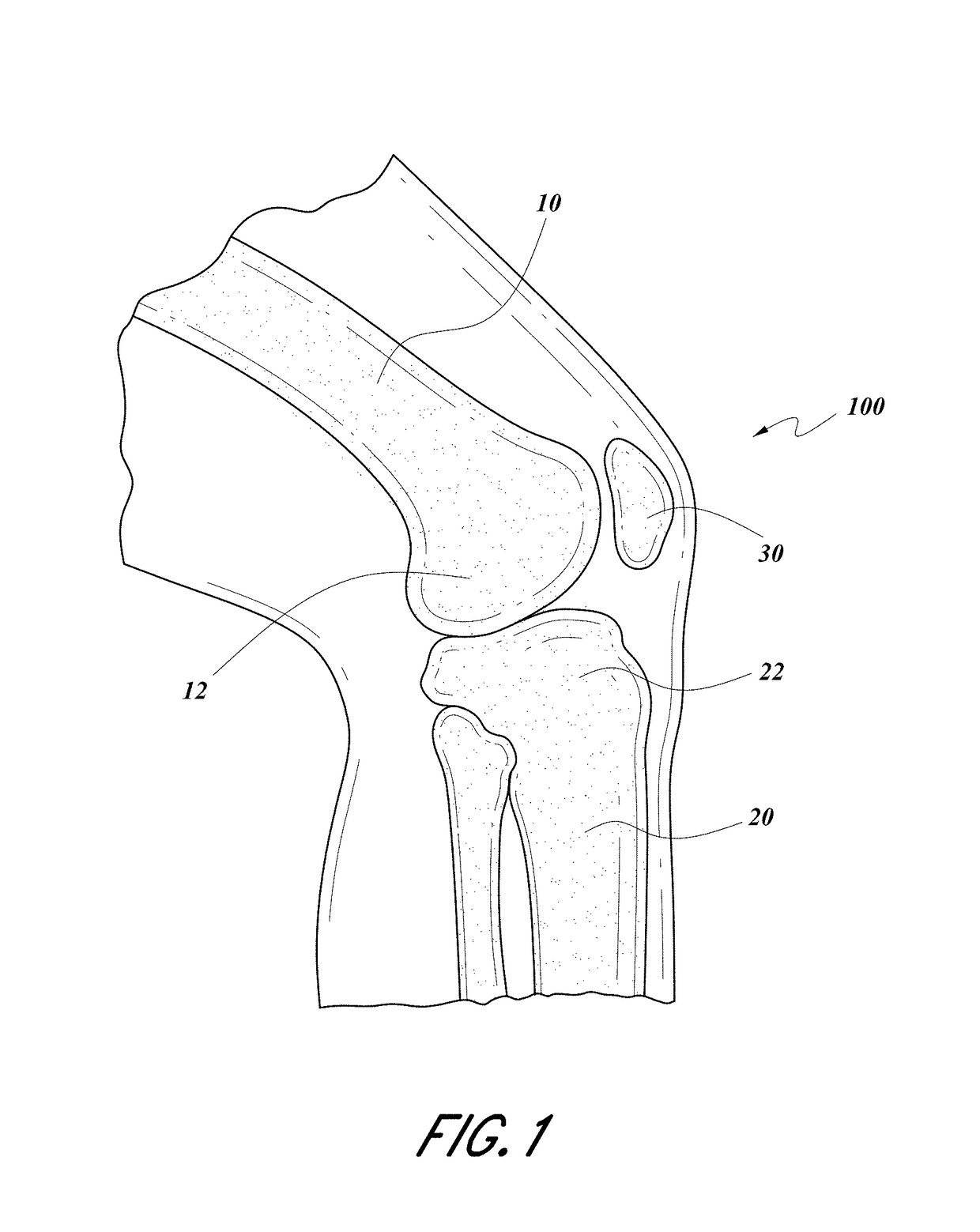 Modular total knee arthroplasty system and method