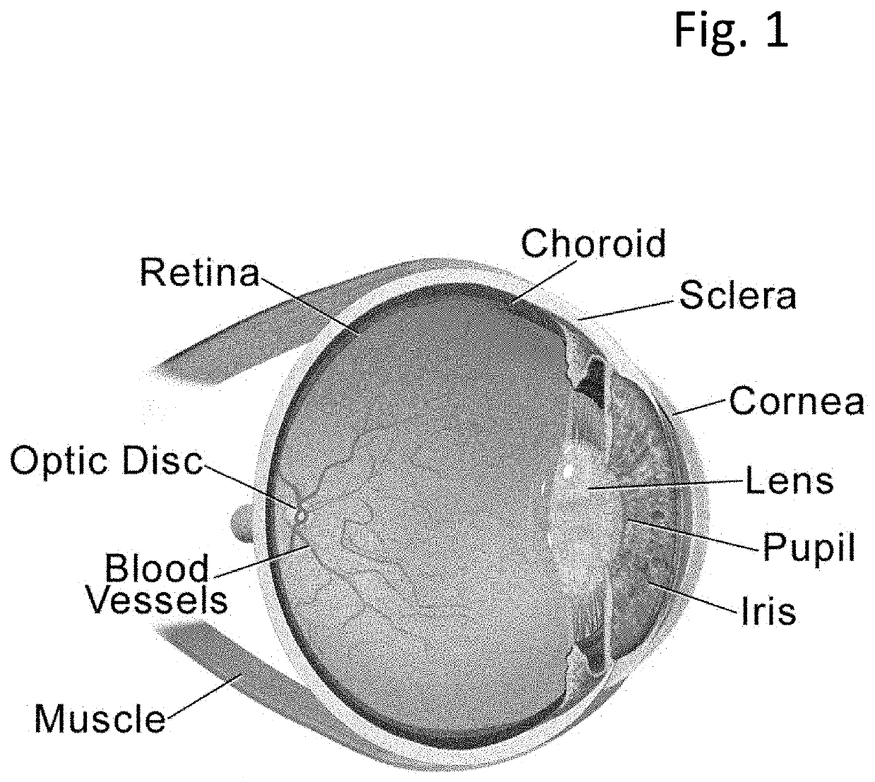 Eye-injectable polymeric nanoparticles and method of use therefor