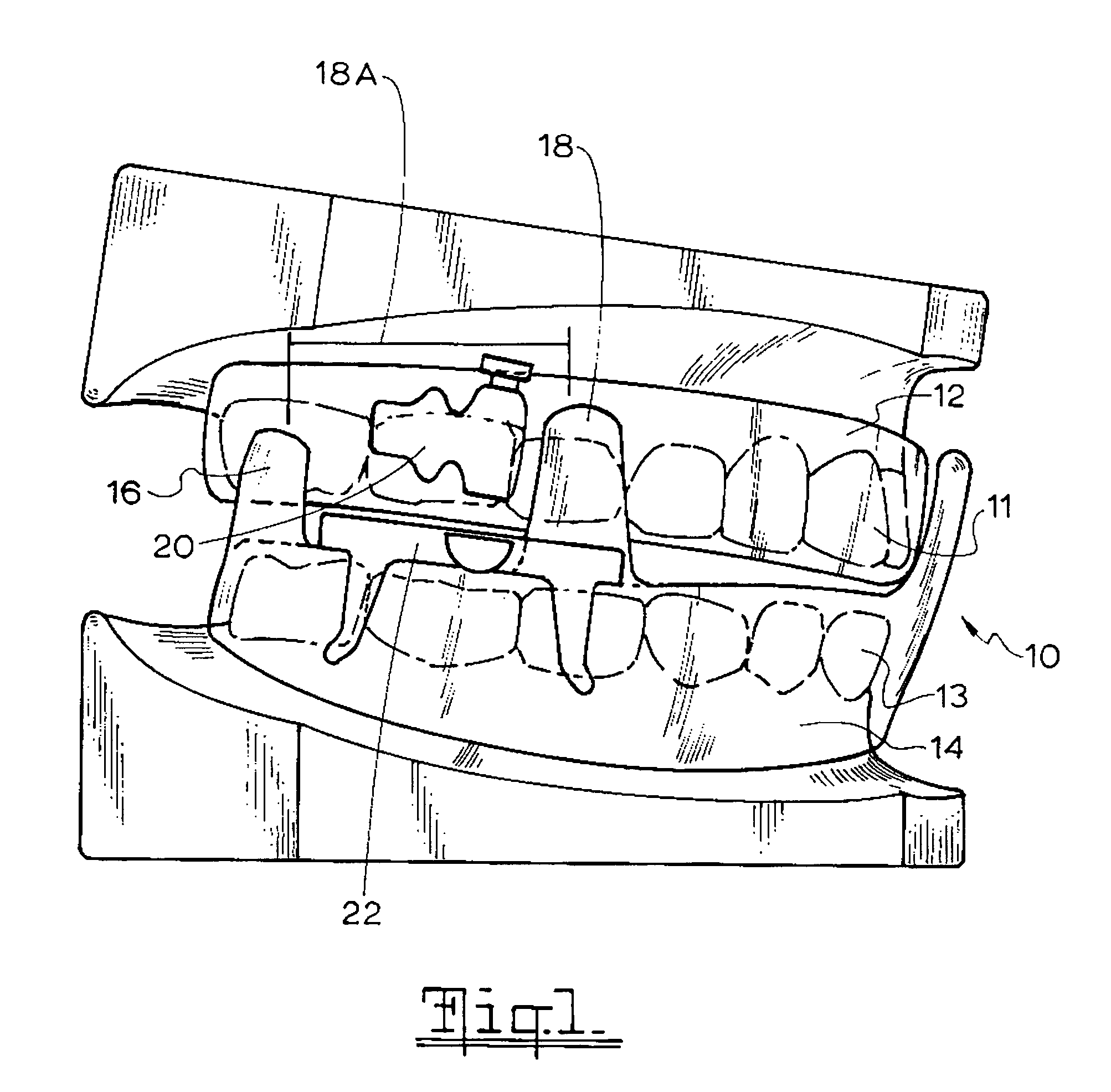 Mandibular advancement device