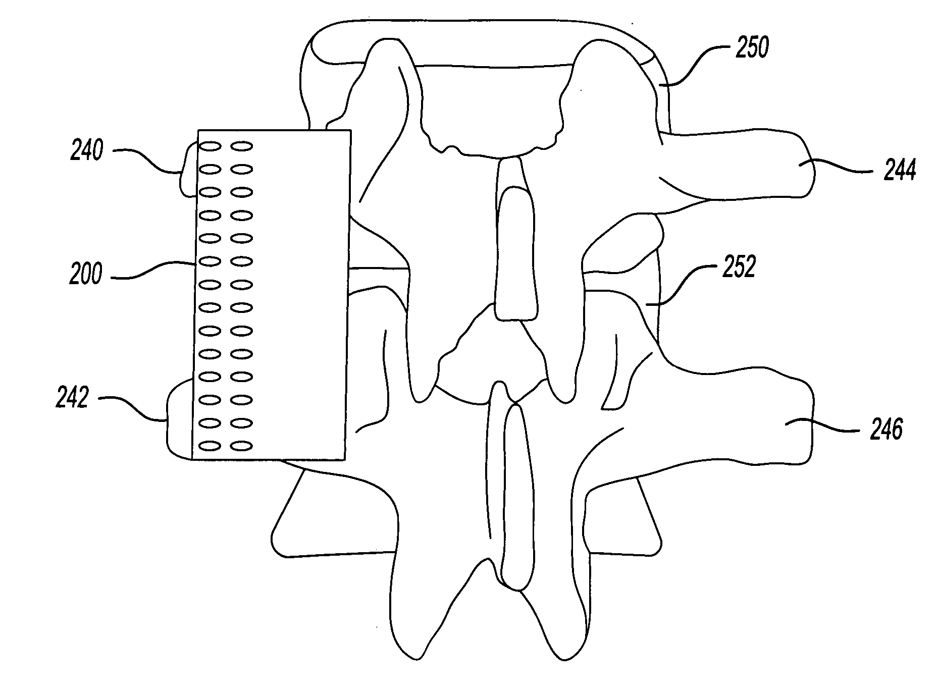 Biodegradable implant for intertransverse process fusion