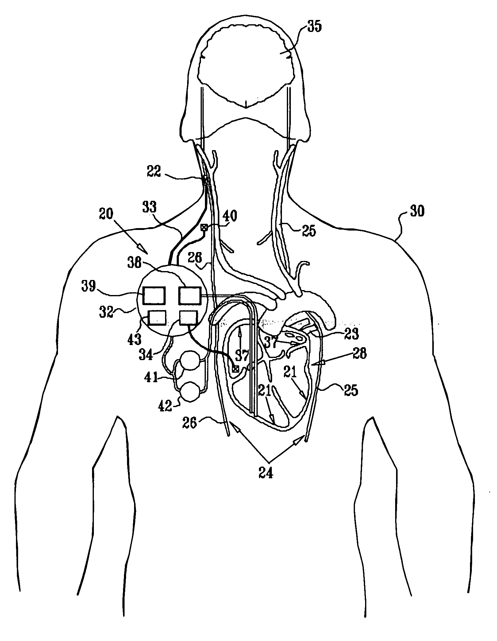 Combined parasympathetic stimulation and cardiac pacing