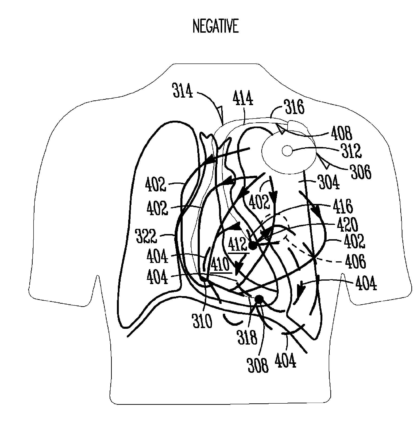 Monitoring fluid in a subject using an electrode configuration providing negative sensitivity regions