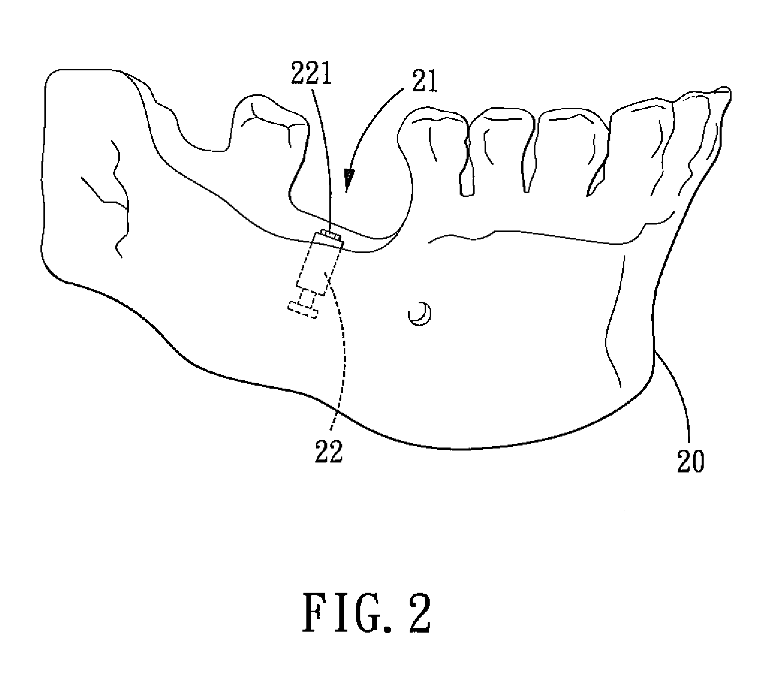 Method for Designing an Abutment