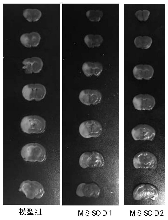 Application of manganese type high-stability superoxide dismutase in prevention or treatment of cerebral apoplexy