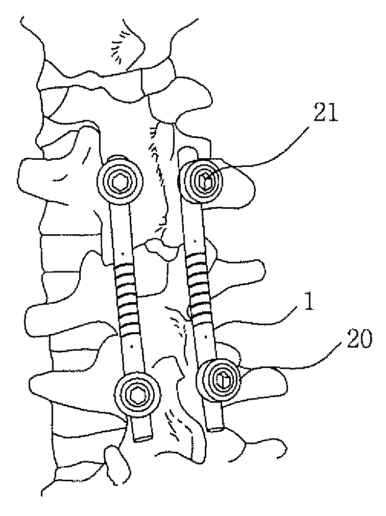 Flexible rod for fixing vertebrae