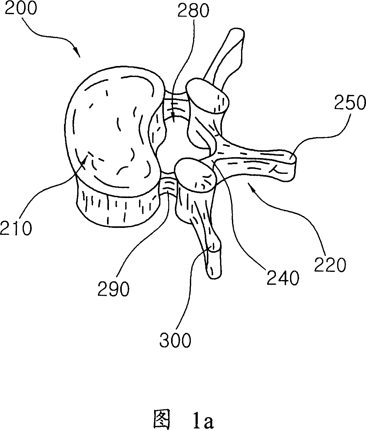 Vertebral arch positioning stent for cervical vertebra spinal canal enlargement operation