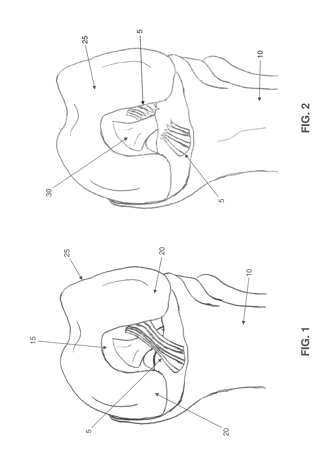 Apparatus and method for anatomic ACL reconstruction