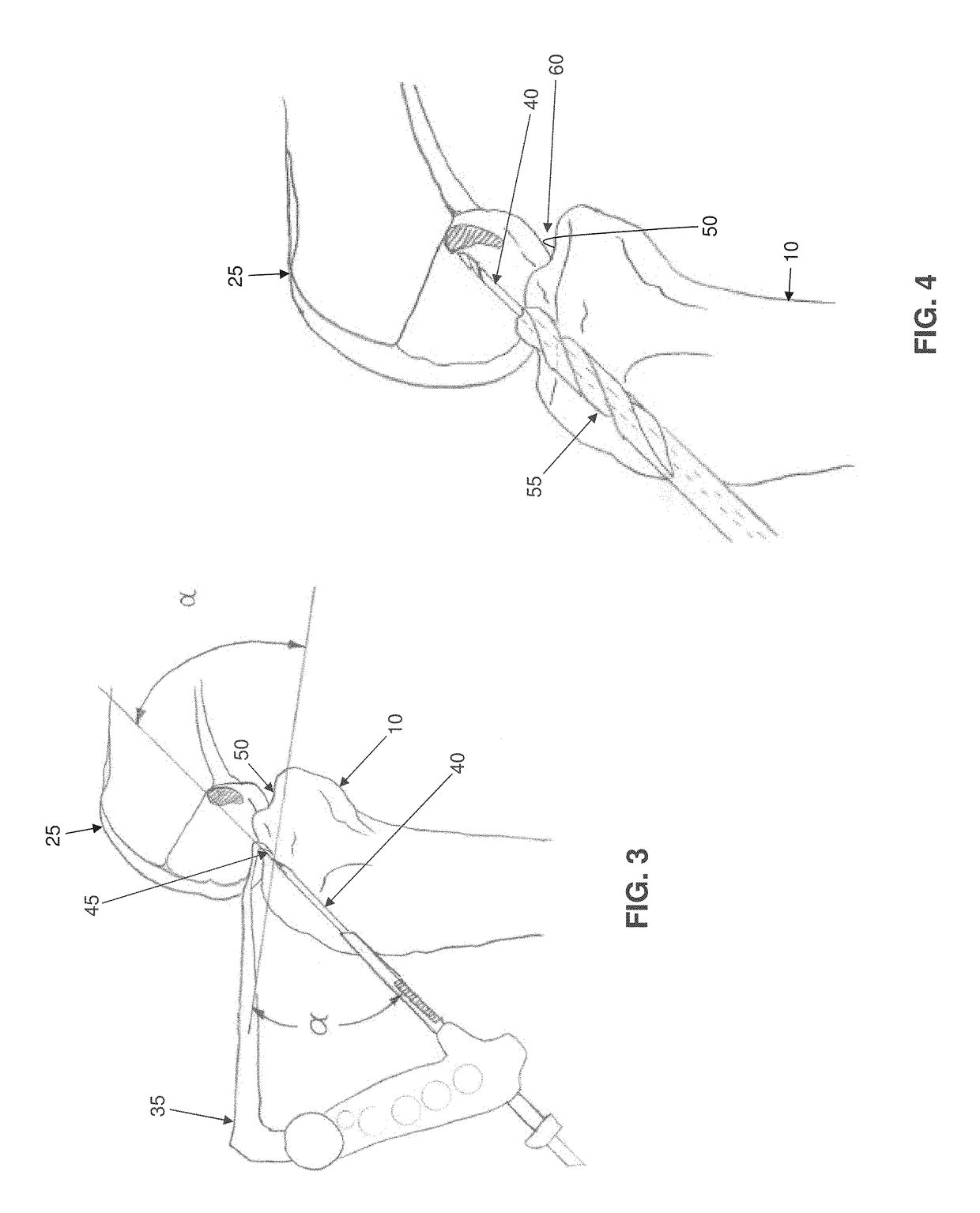 Apparatus and method for anatomic ACL reconstruction