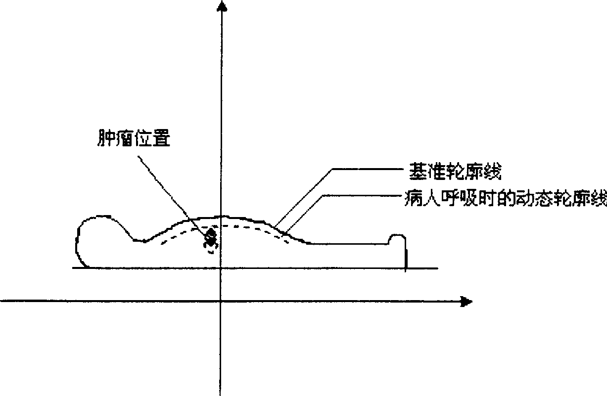 Method of non contact measuring breast belly tumour position for radiation treatment