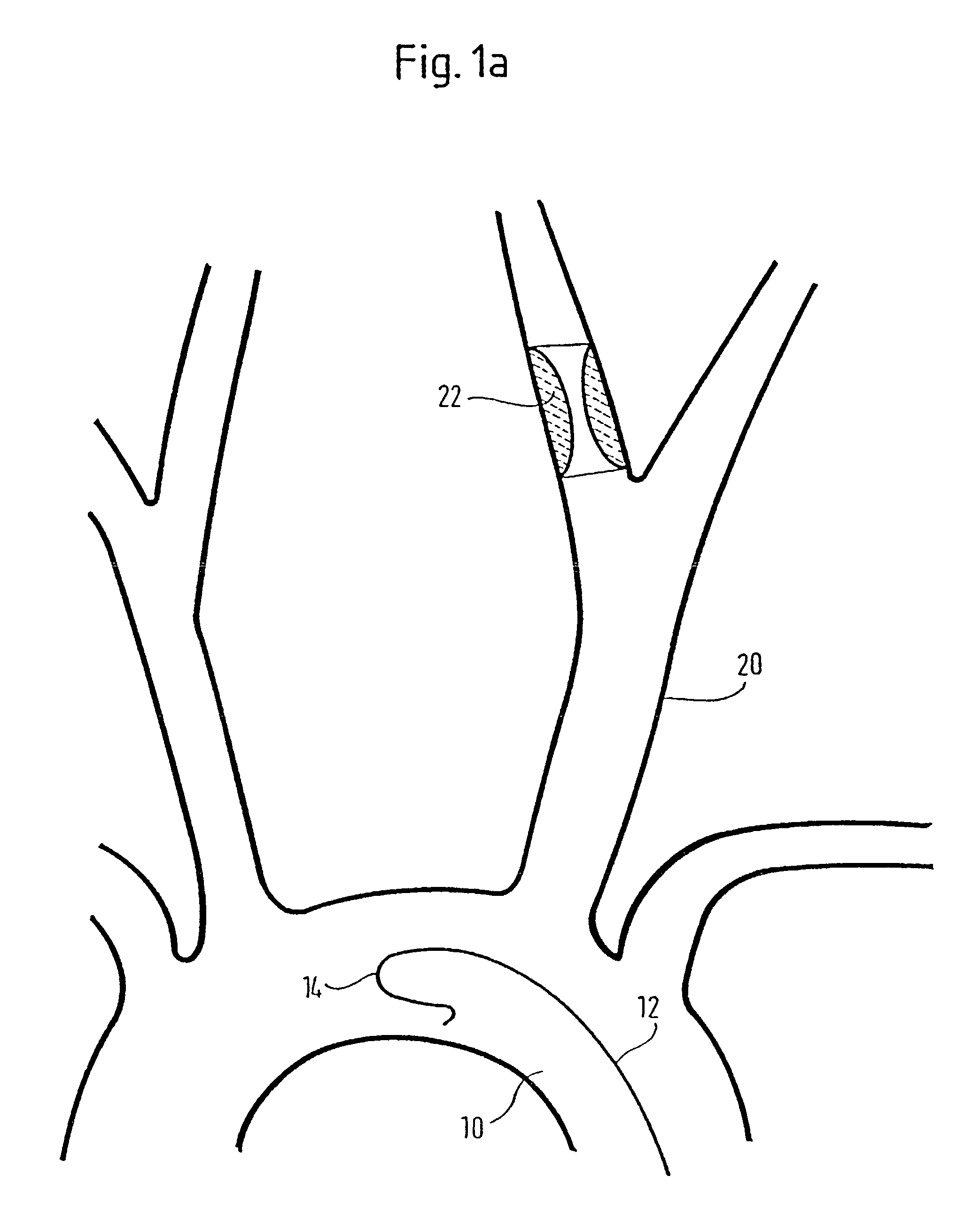 Implant delivery device