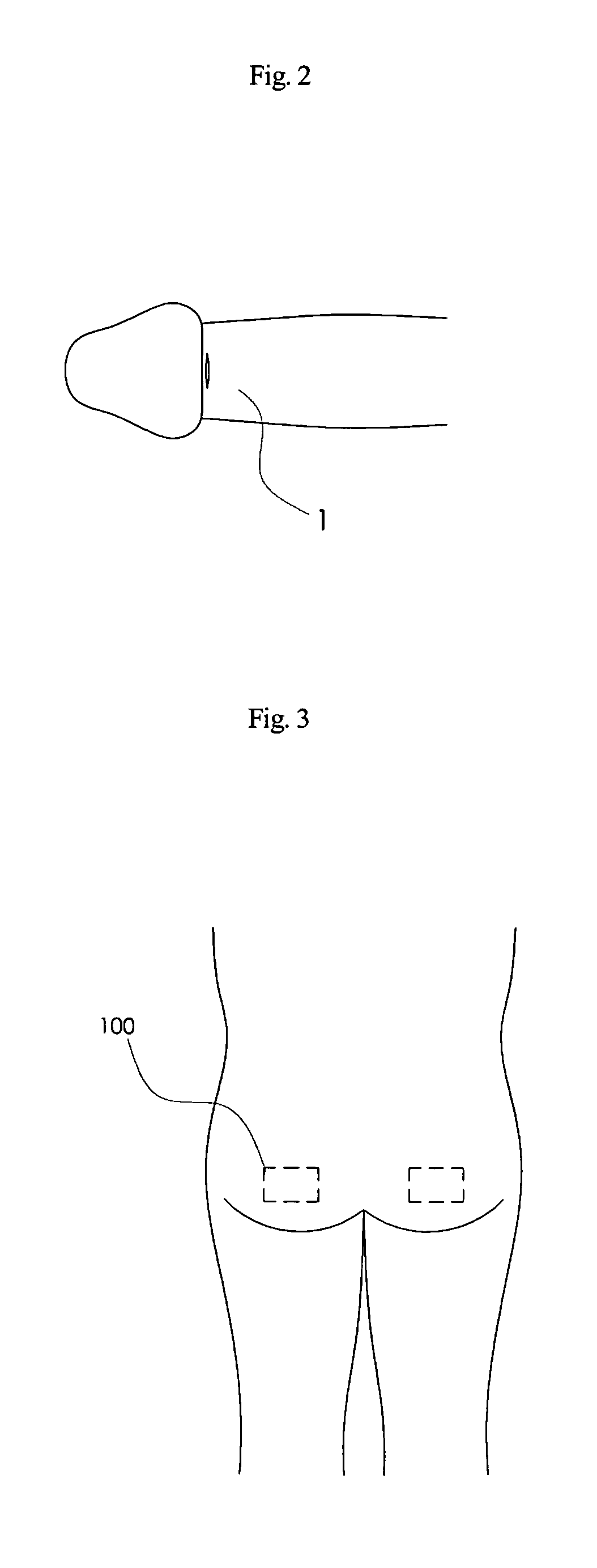 Novel methods of phalloplasty using multiple slits tissue or multiple pieces tissue