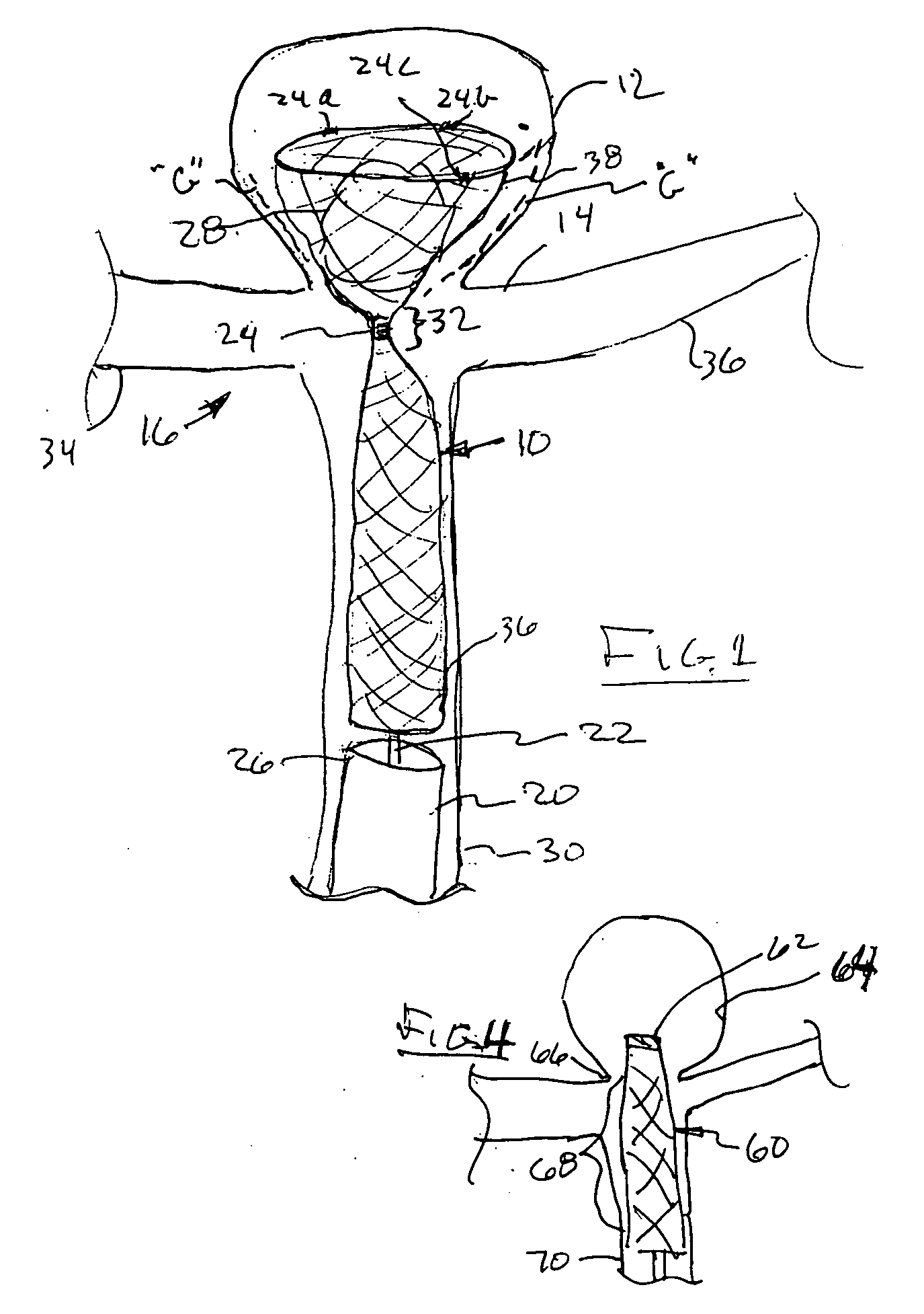 Cranial aneurysm treatment arrangement