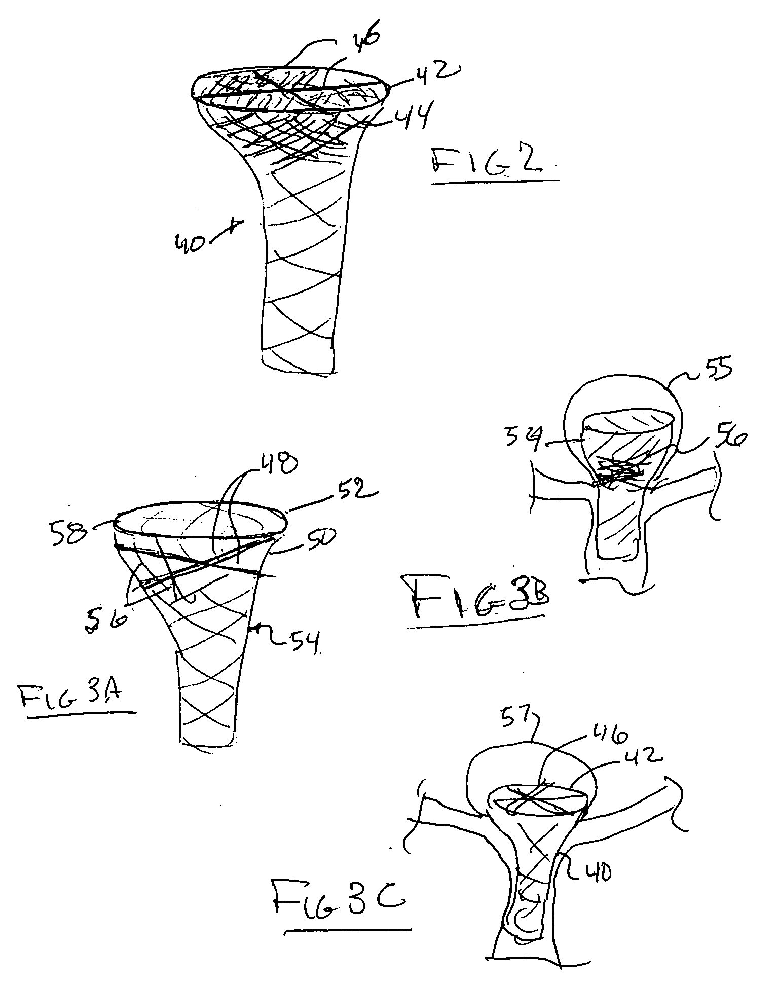 Cranial aneurysm treatment arrangement