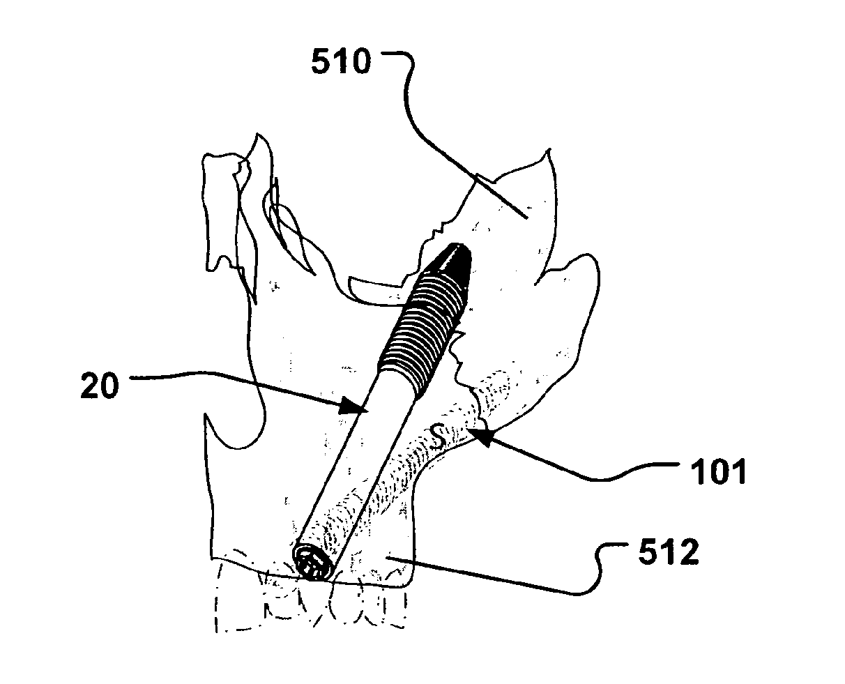 Medical implant and method of implantation