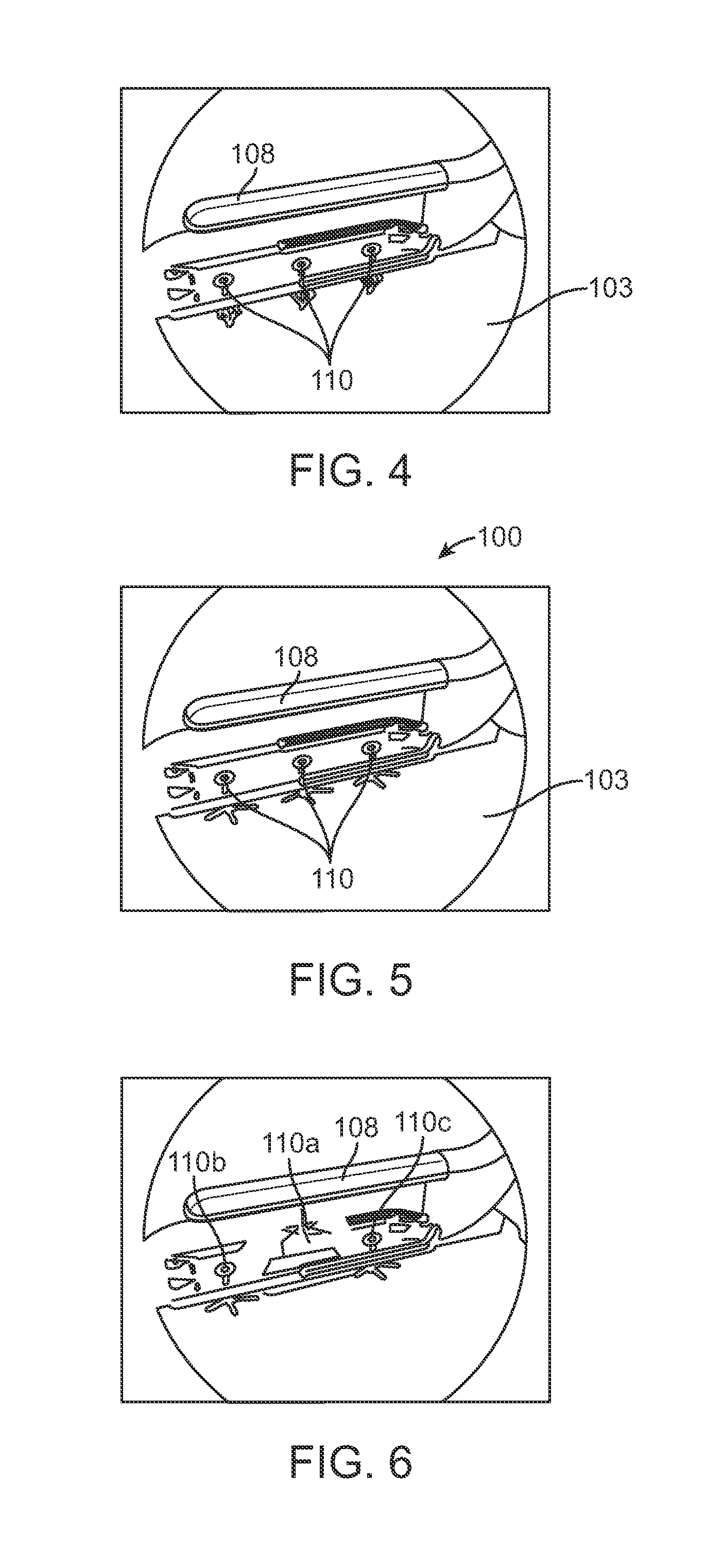 Method and device for treating dysfunctional cardiac tissue