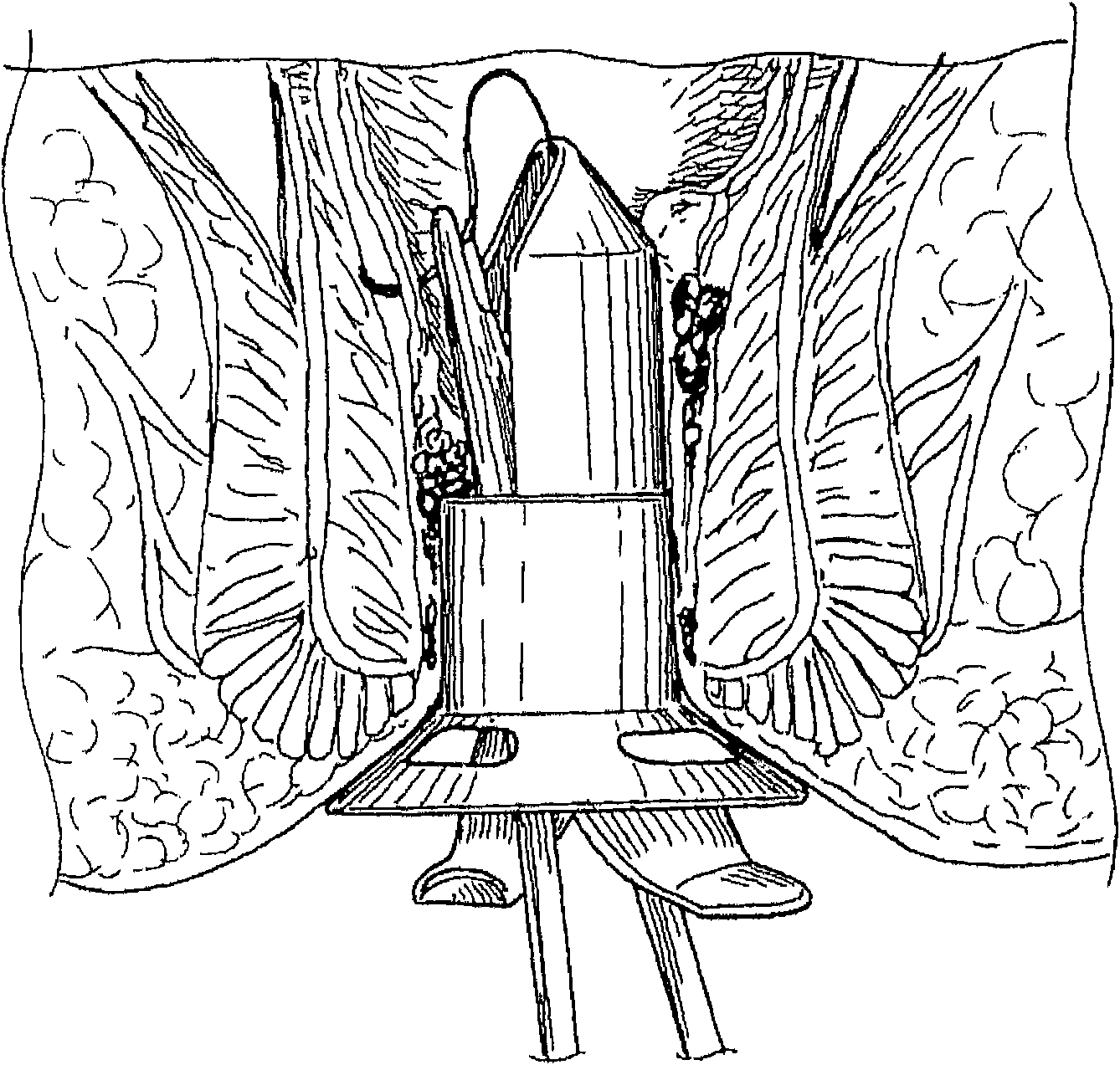 A surgical device for transanally accessing the rectum of a patient