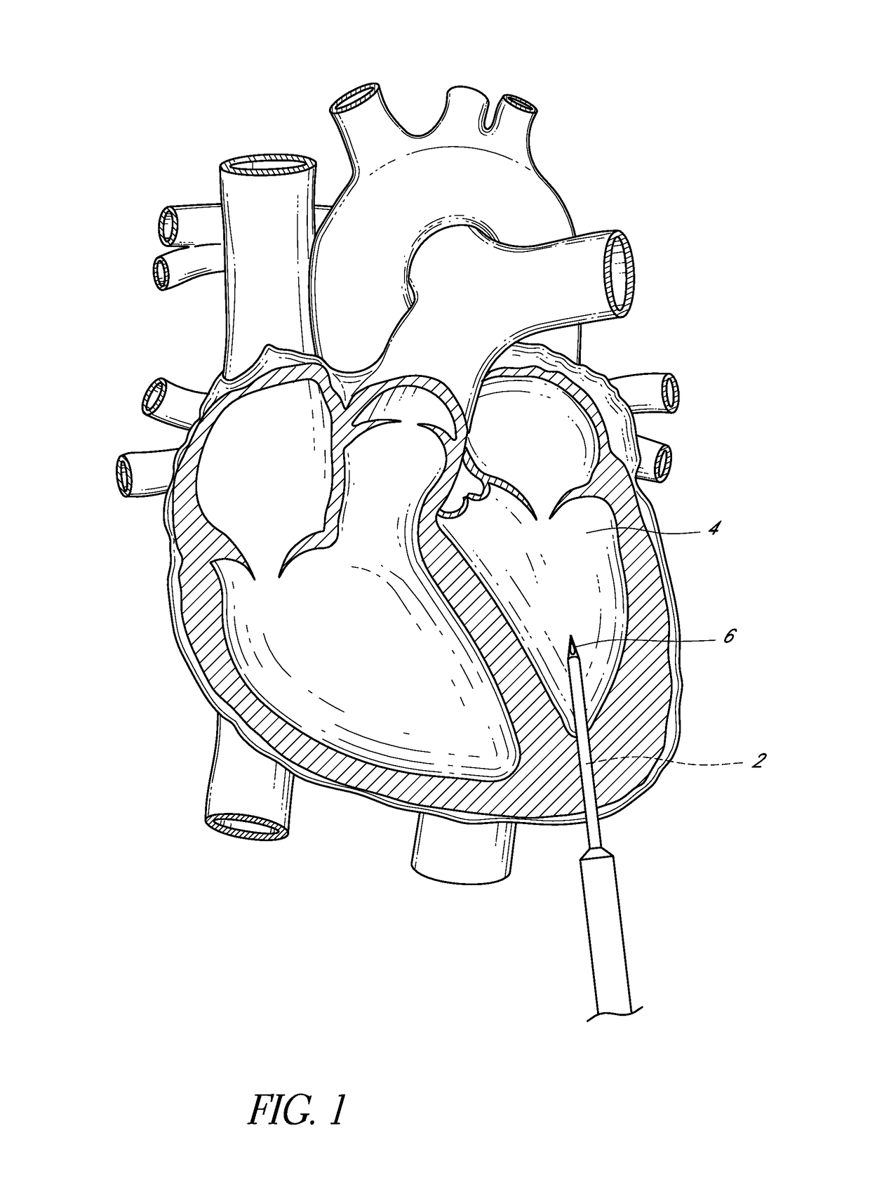 Cardiovascular access and device delivery system