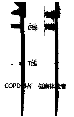 PRDX2 antibody colloidal gold detection test strip for rapidly screening patients with chronic obstructive pneumonia in situ