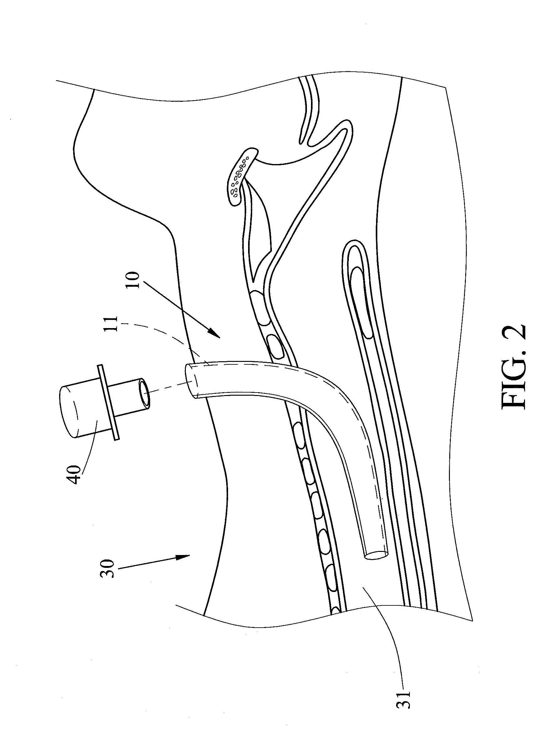 Device for Positioning Tracheostomy Tube