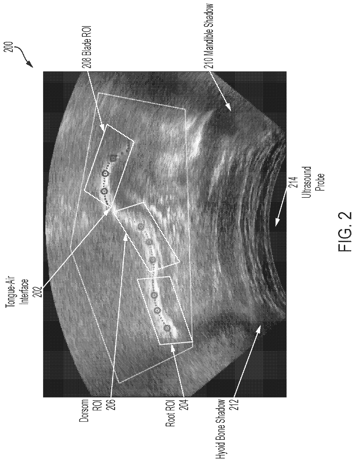 Simplified, Interactive, Real-Time Ultrasound Biofeedback System for Speech Remediation