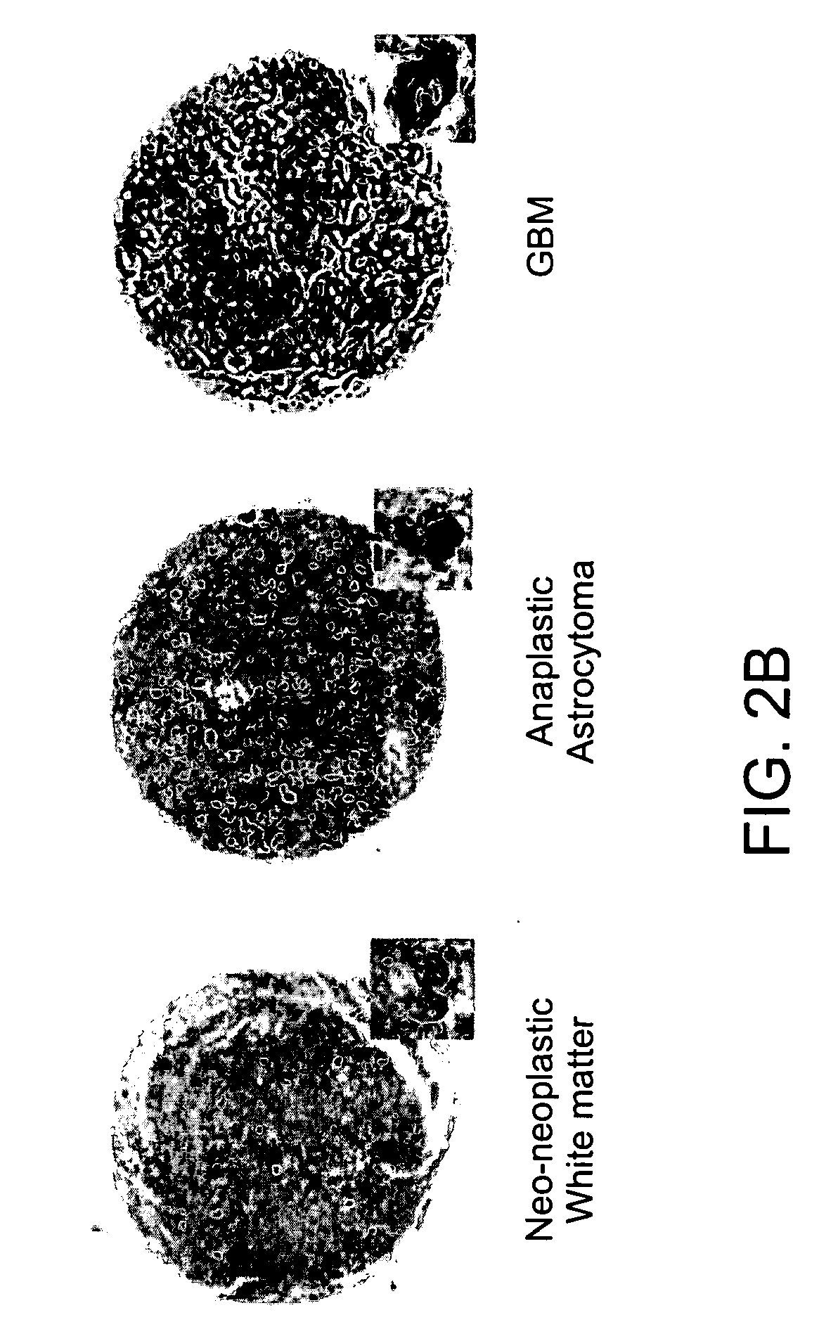 Compositions and methods for the treatment of neoplasia