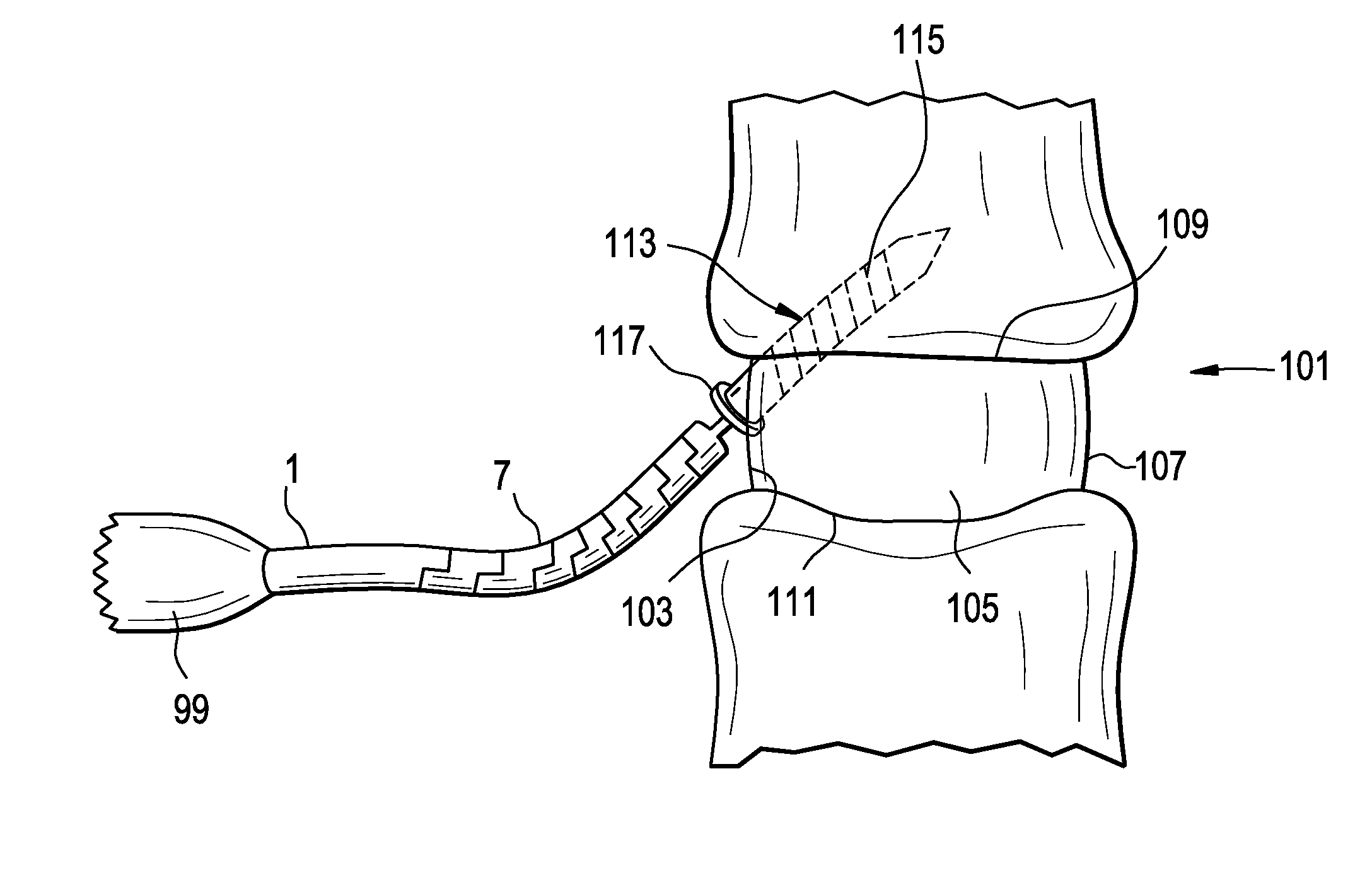 Flexible Spinal Driver or Drill With A Malleable Core, and/or Fixed Core Radius