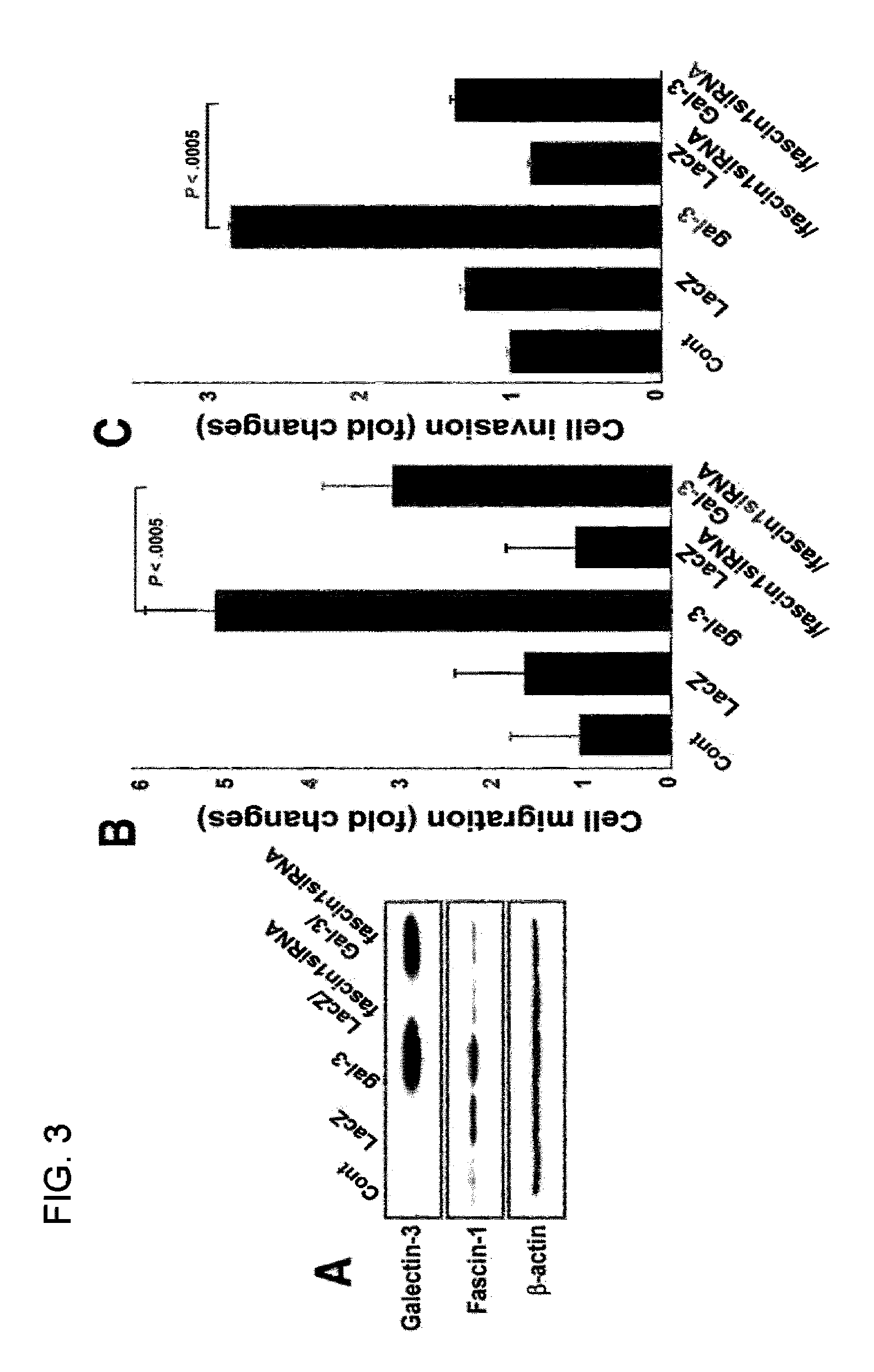 Method for screening cancer therapeutic agent using galectin-3, GSK-3β, and fascin-1