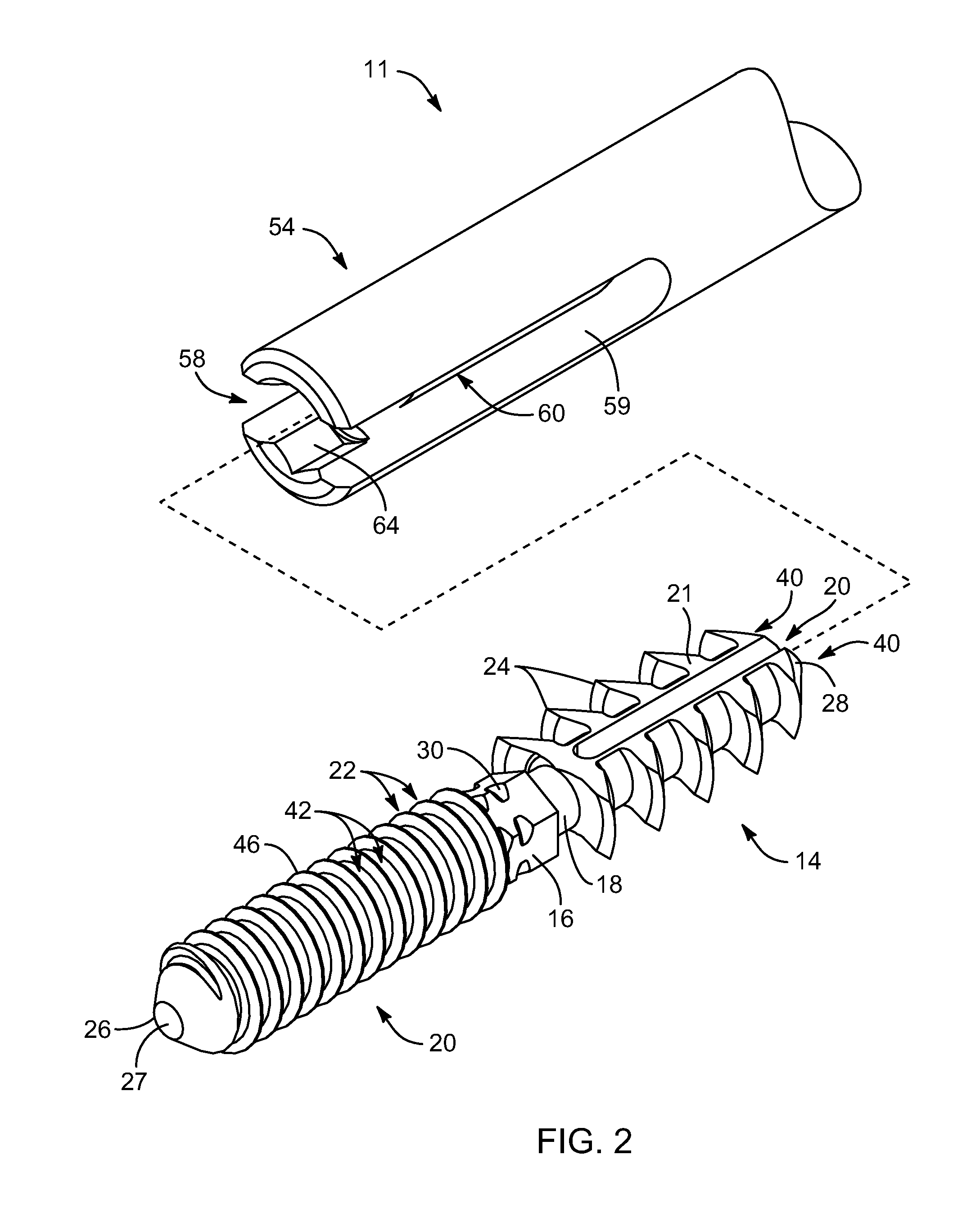 Arthrodesis implant apparatus and method