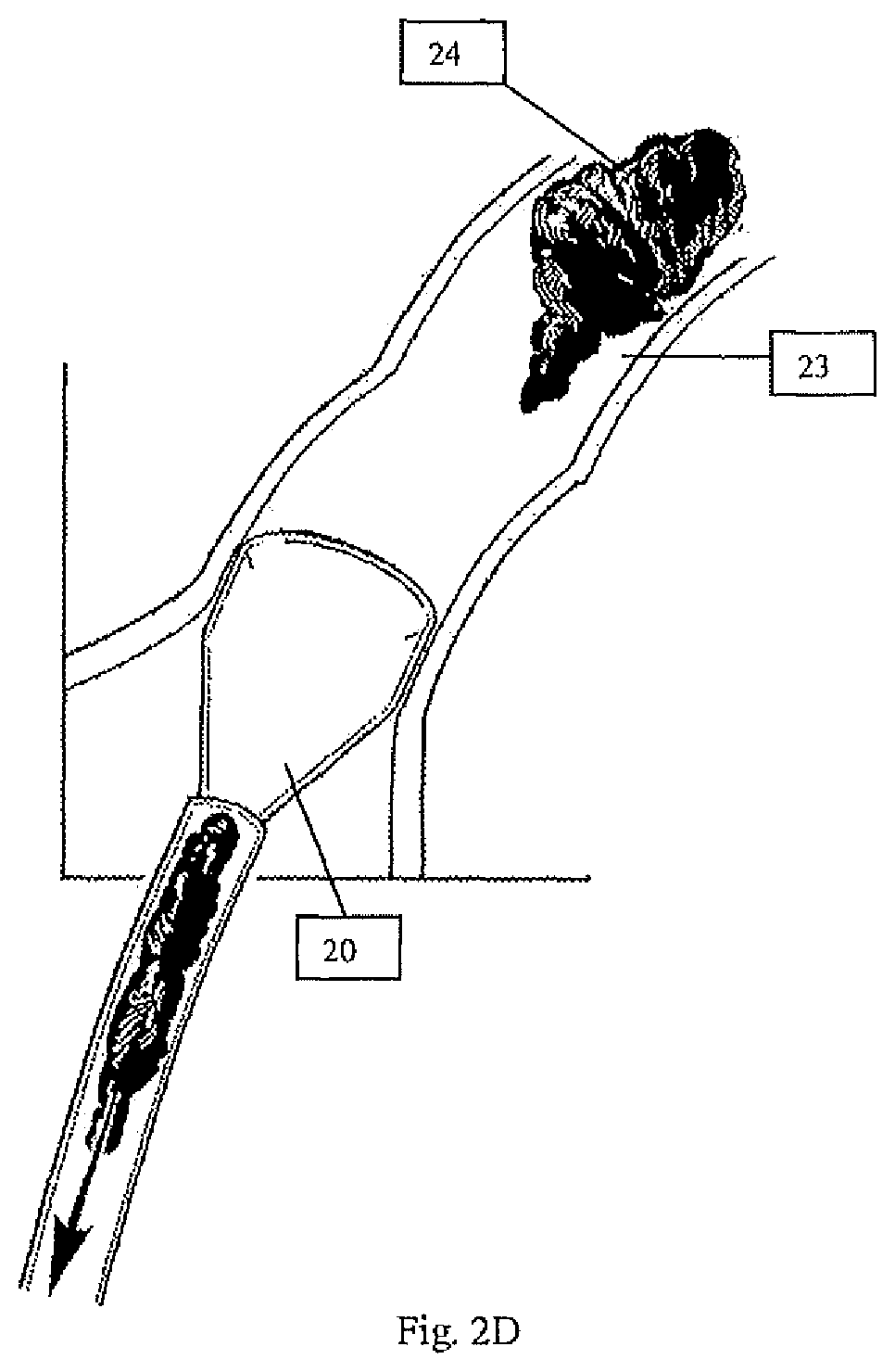 Systems and methods for removing undesirable material within a circulatory system utilizing a balloon catheter