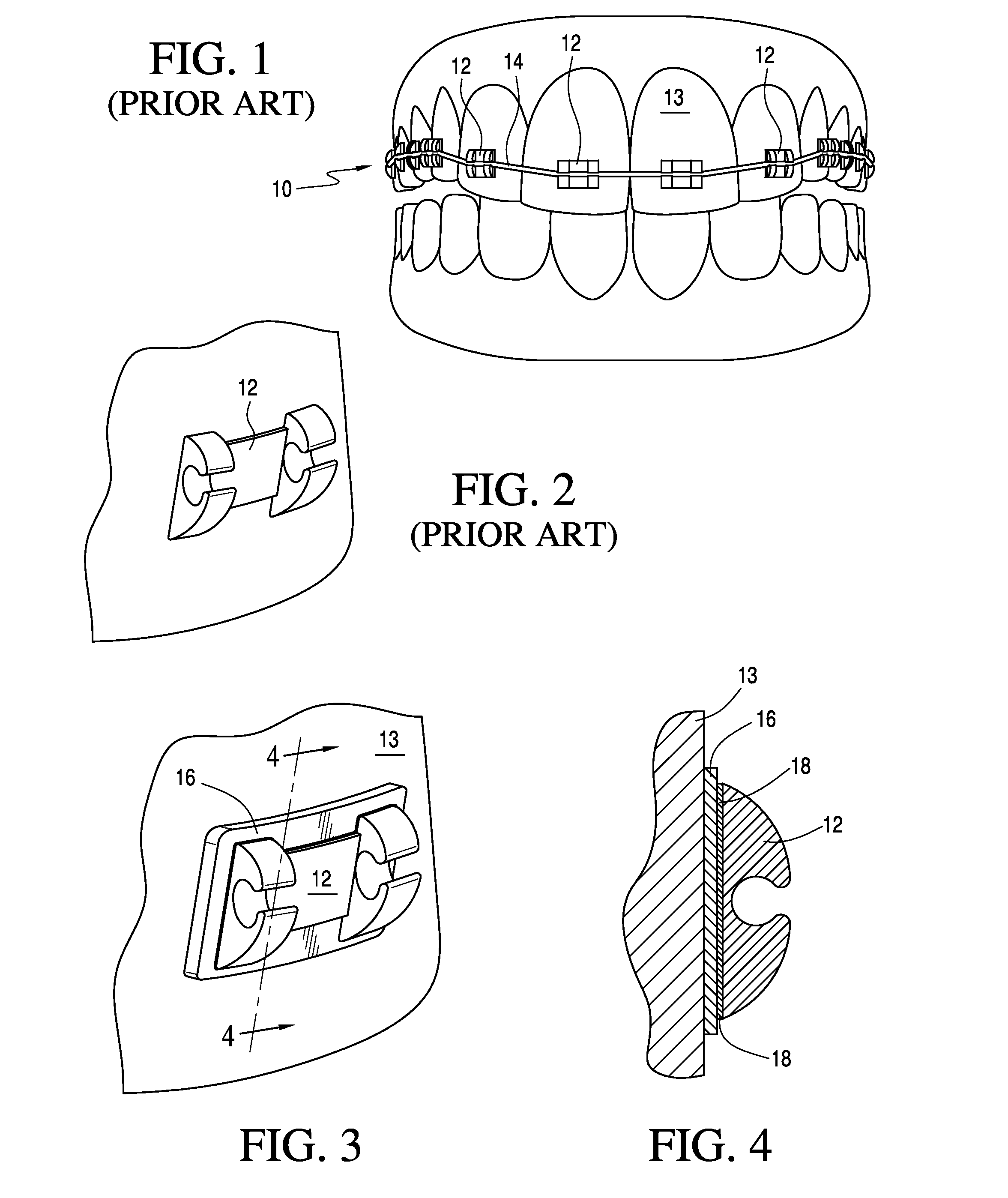 Adjustable orthodontic bracket and method