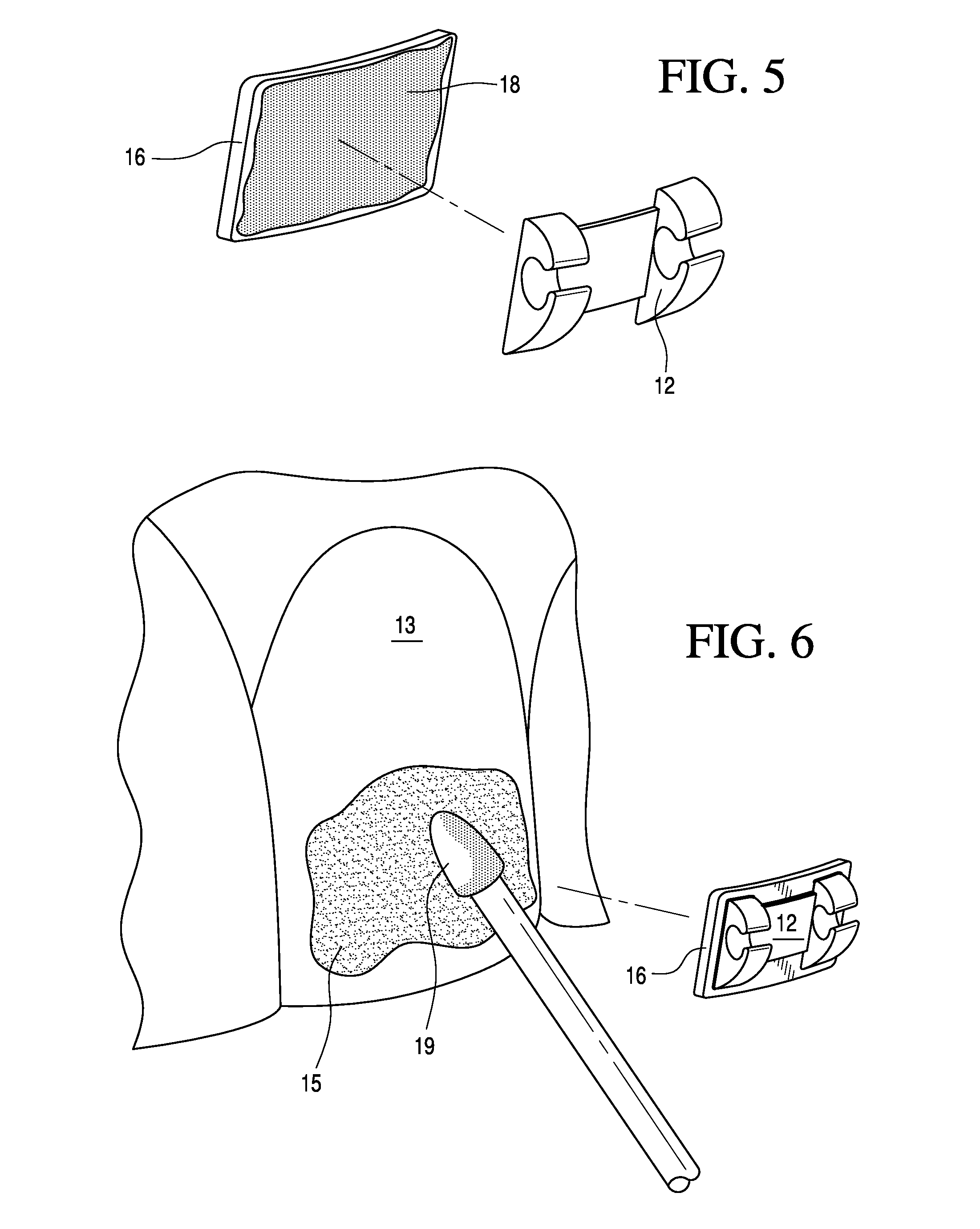 Adjustable orthodontic bracket and method