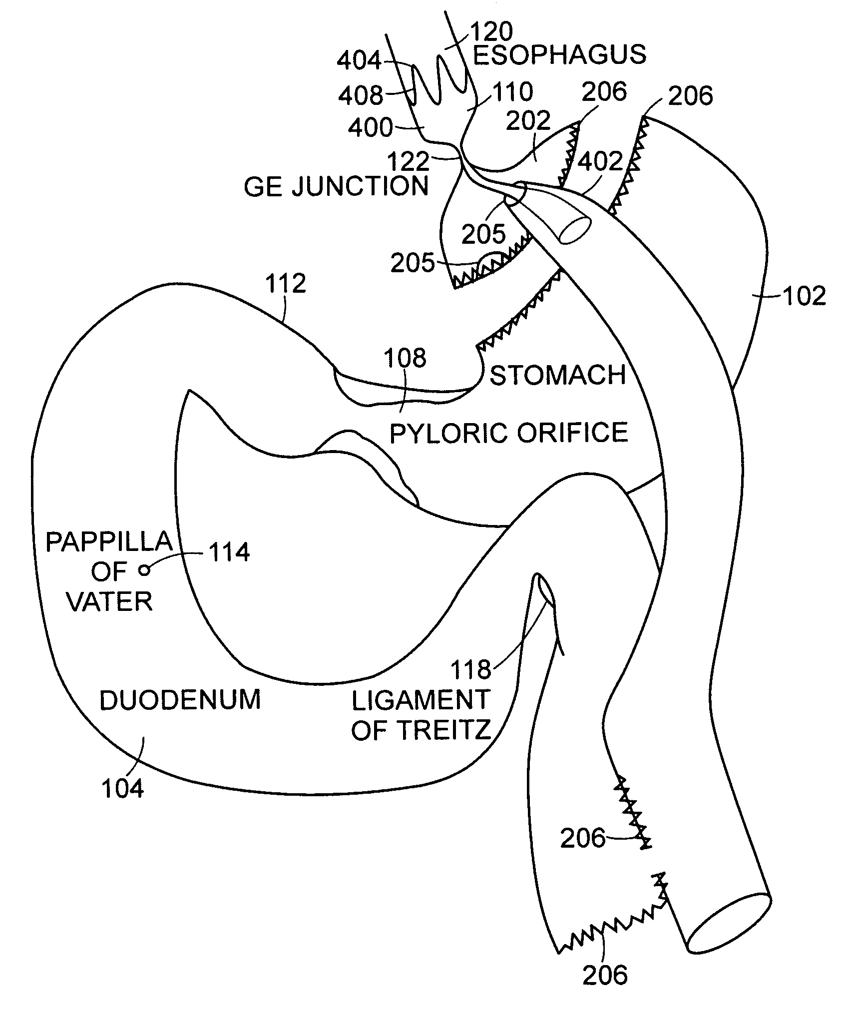 Use of a gastrointestinal sleeve to treat bariatric surgery fistulas and leaks