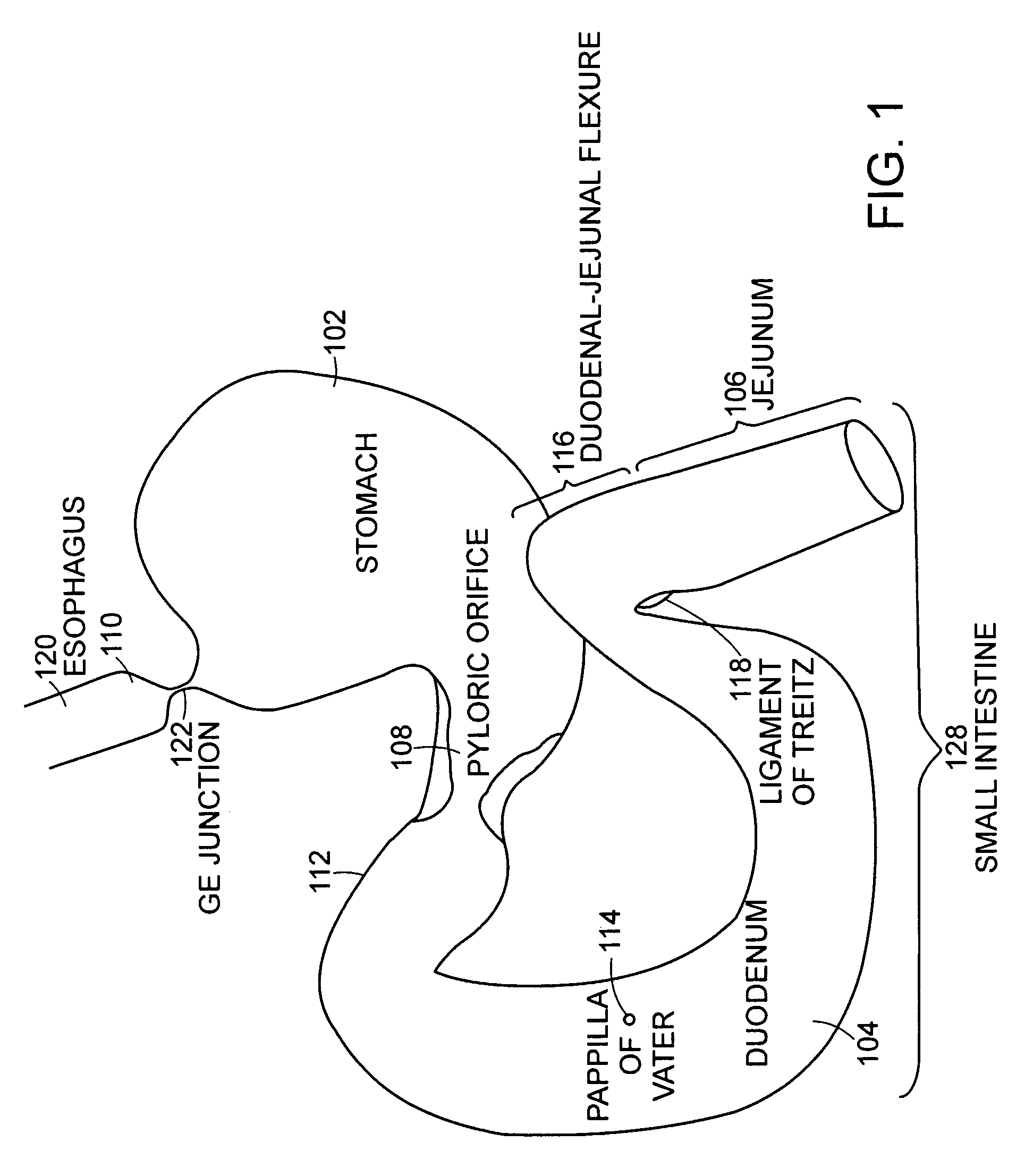 Use of a gastrointestinal sleeve to treat bariatric surgery fistulas and leaks