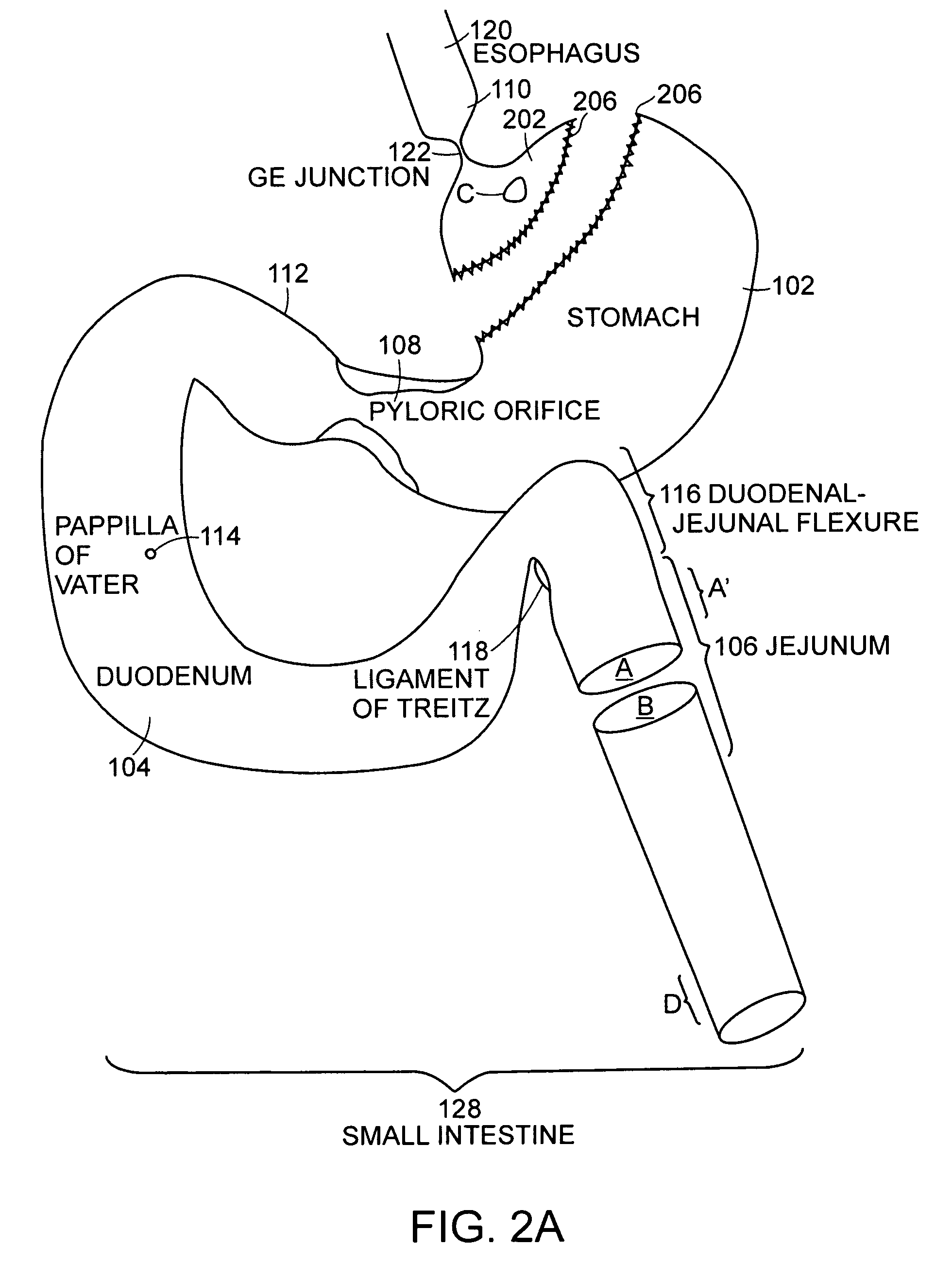 Use of a gastrointestinal sleeve to treat bariatric surgery fistulas and leaks