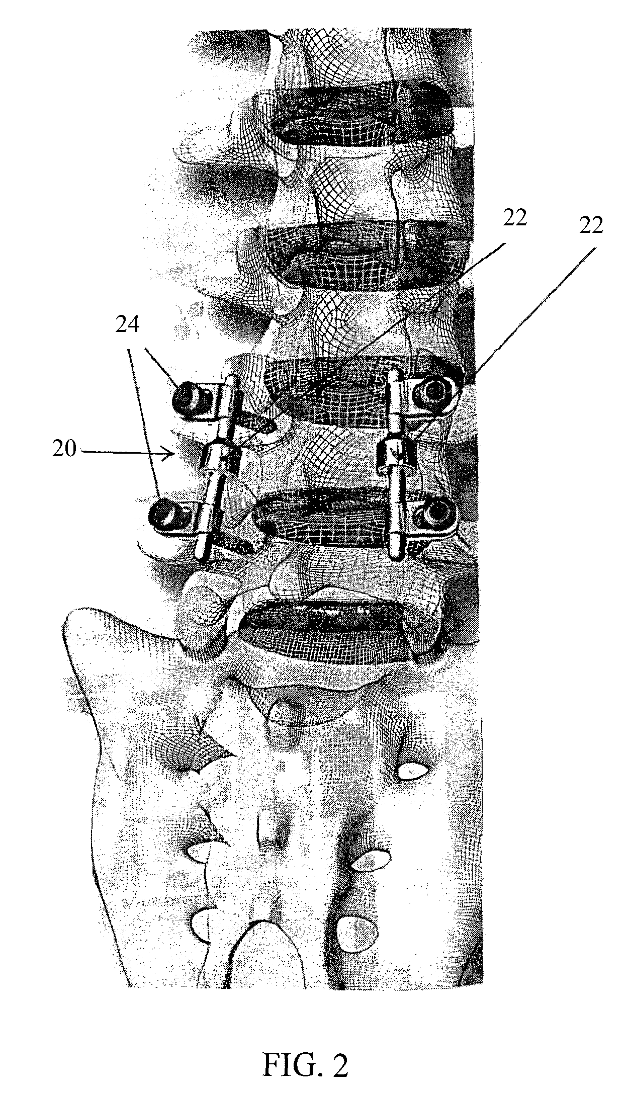 Spinal implant having a post-operative adjustable dimension