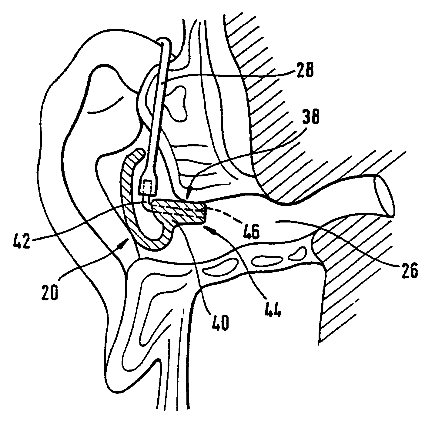 Otoplasty for behind-the-ear (BTE) hearing aids