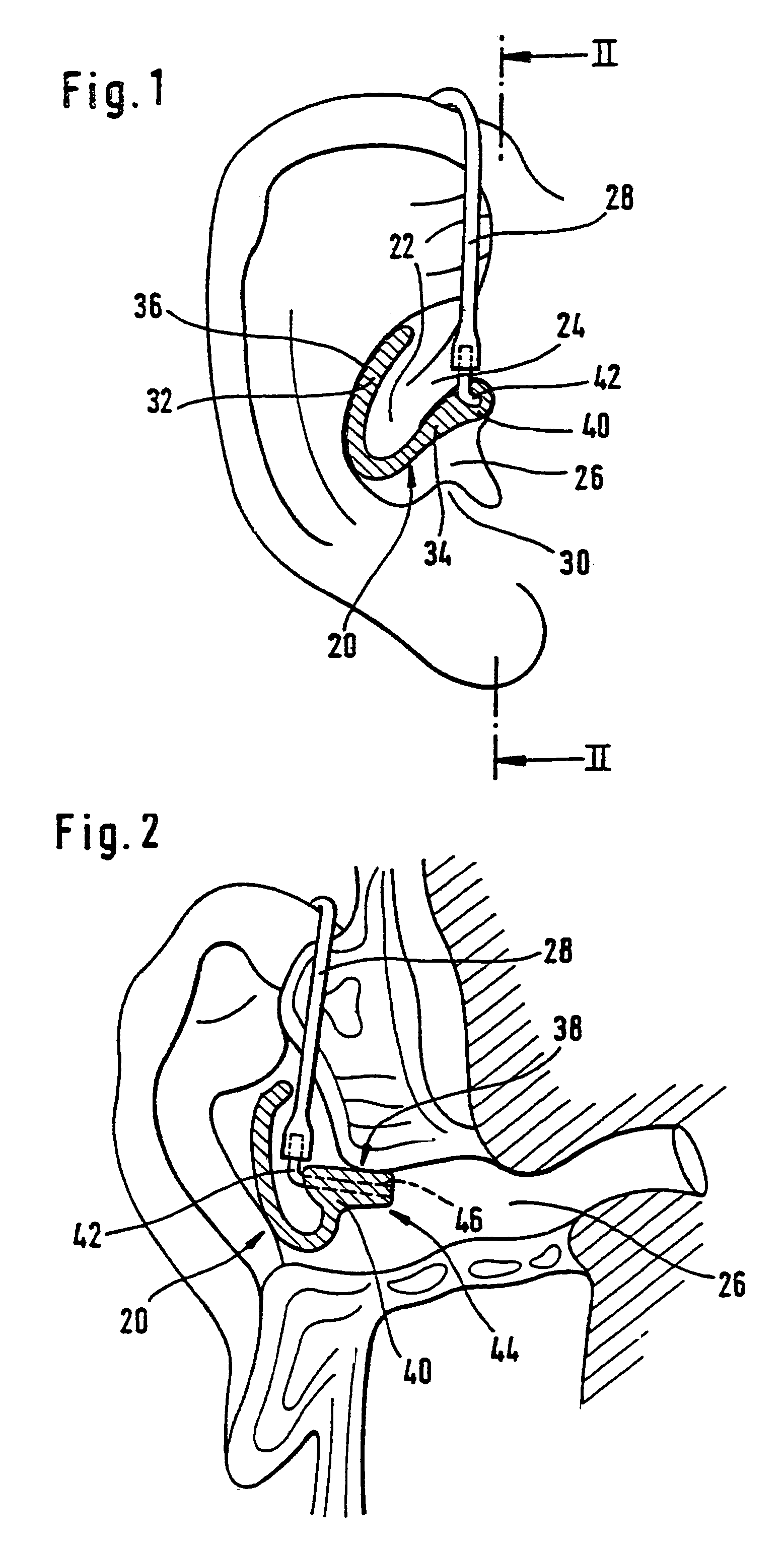 Otoplasty for behind-the-ear (BTE) hearing aids