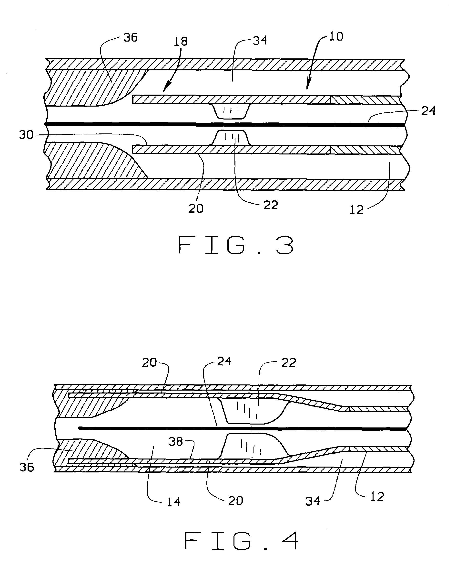 Expandable laser catheter