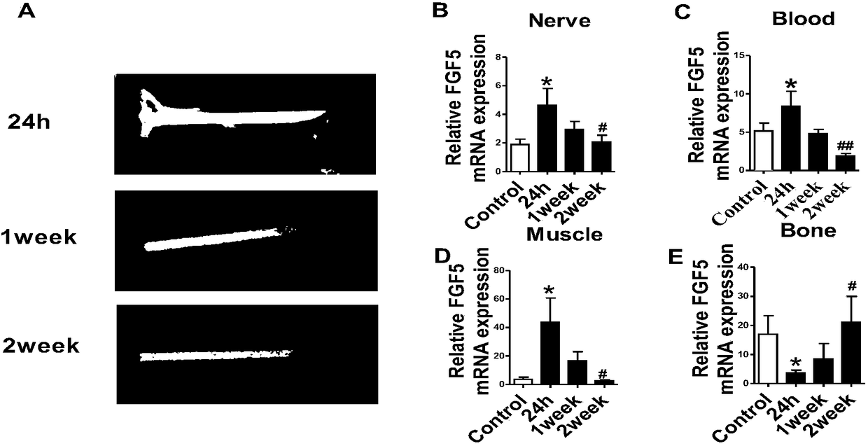 Application of recombinant human basic fibroblast growth factor-5 in promotion of fracture healing