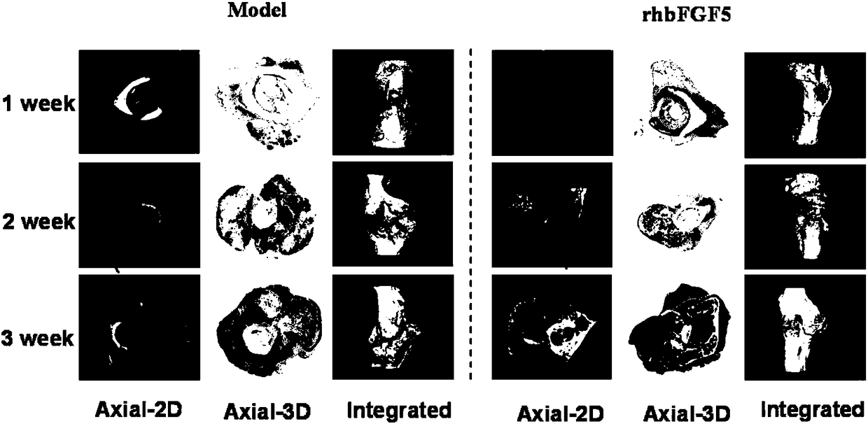 Application of recombinant human basic fibroblast growth factor-5 in promotion of fracture healing