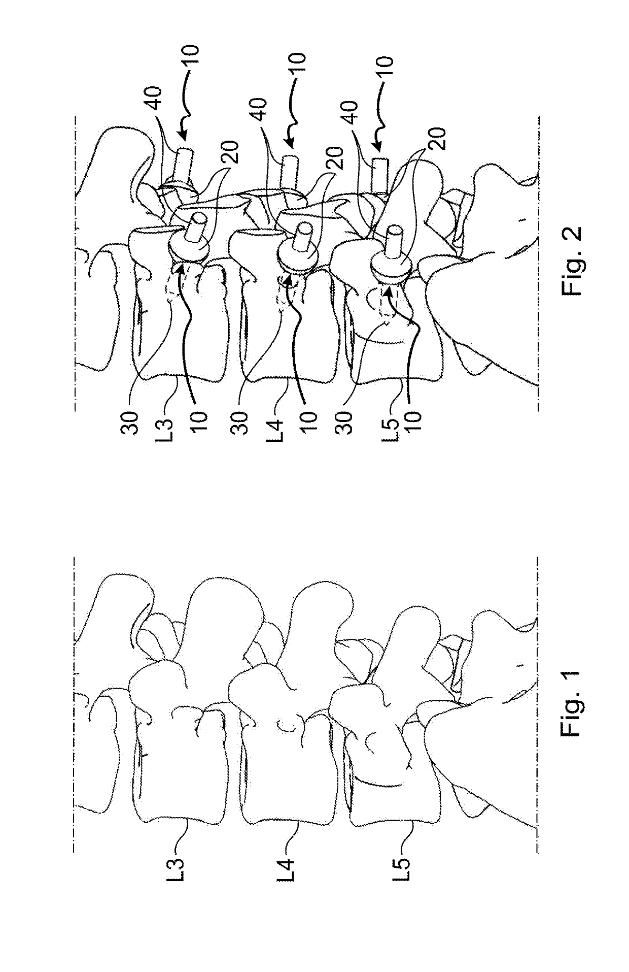 Vertebral stabilisation device