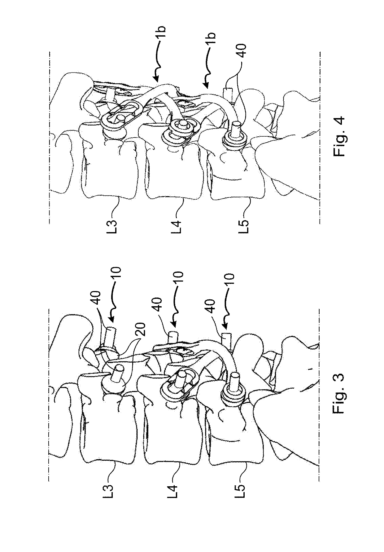 Vertebral stabilisation device