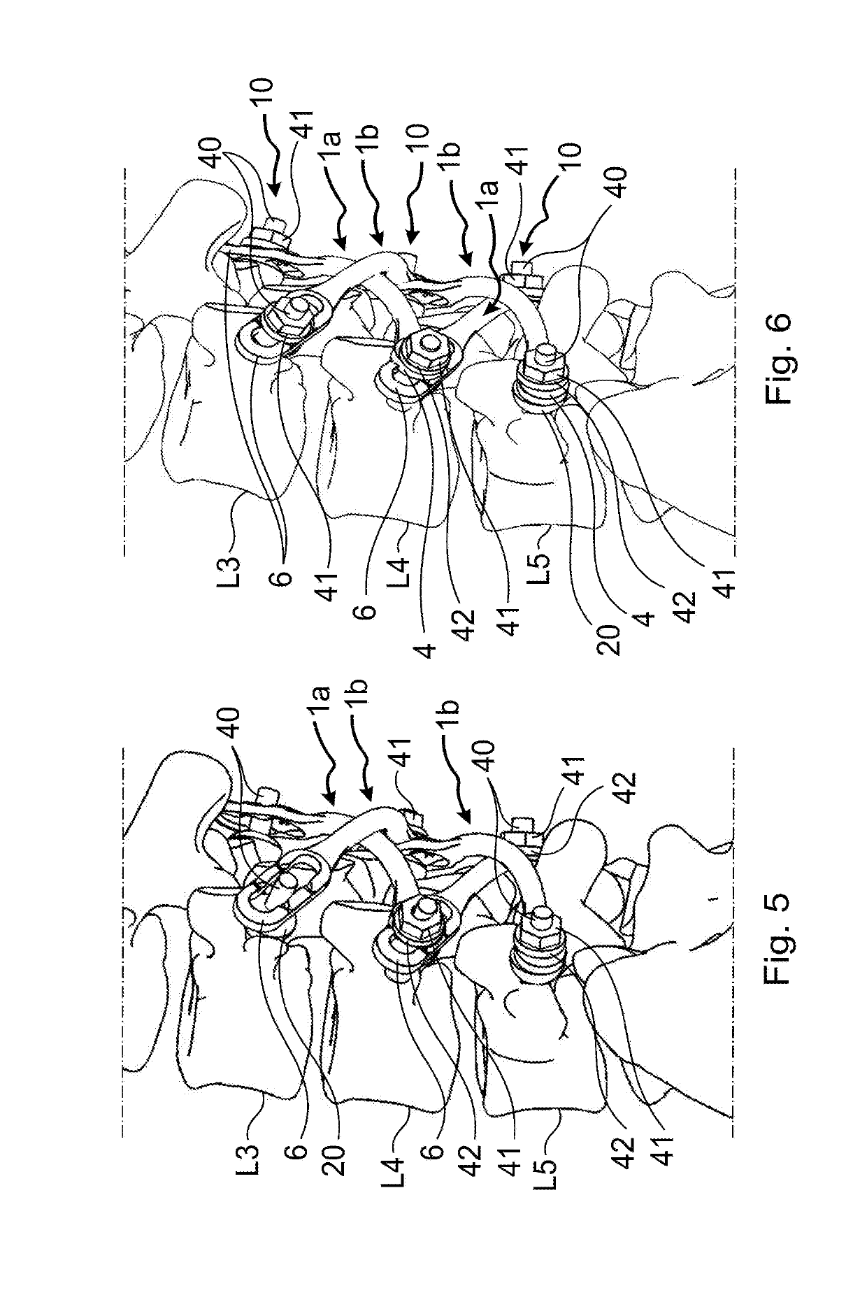 Vertebral stabilisation device