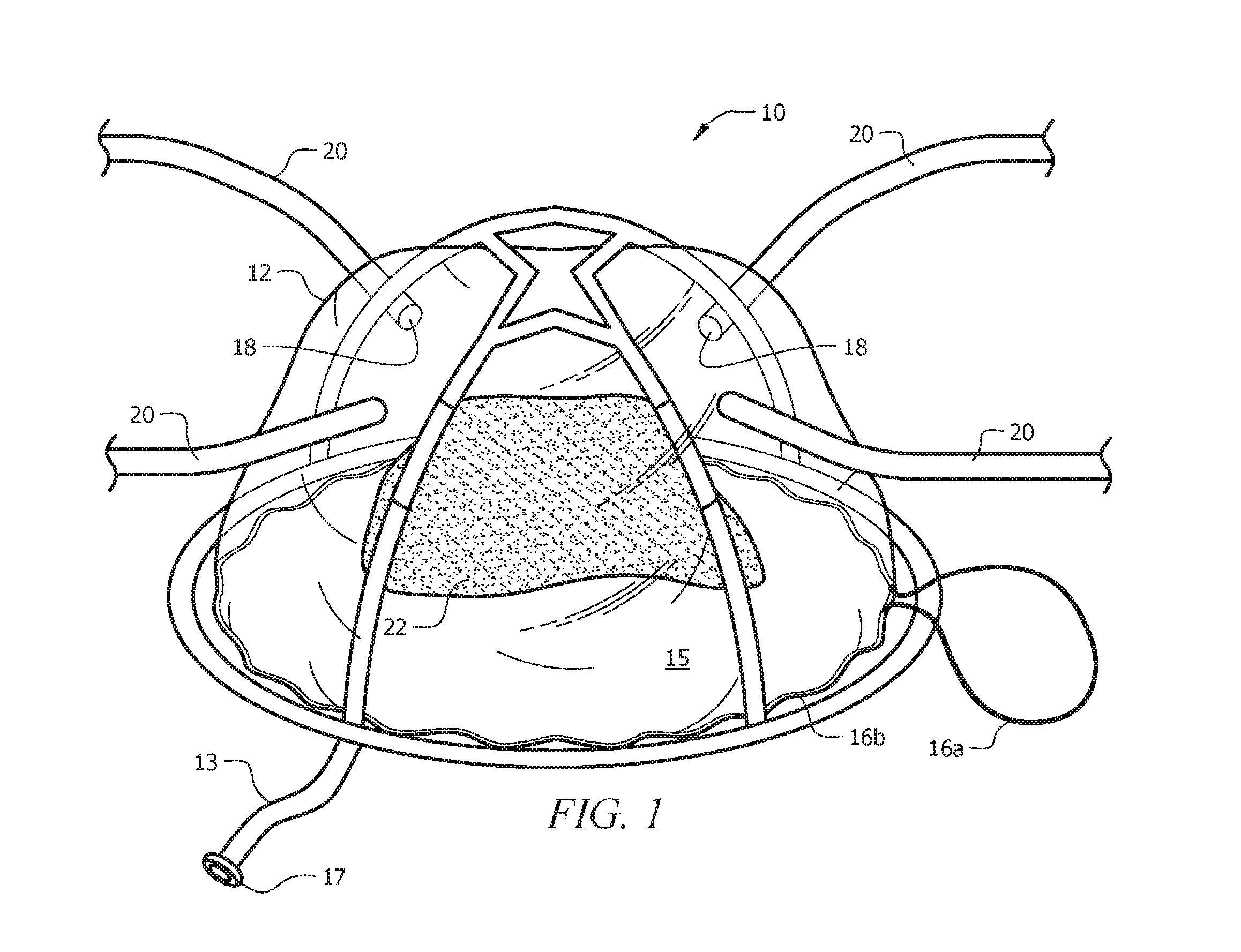 Pneumatic system and method for intermittently rigidifying an endoscopic specimen retaining carrier