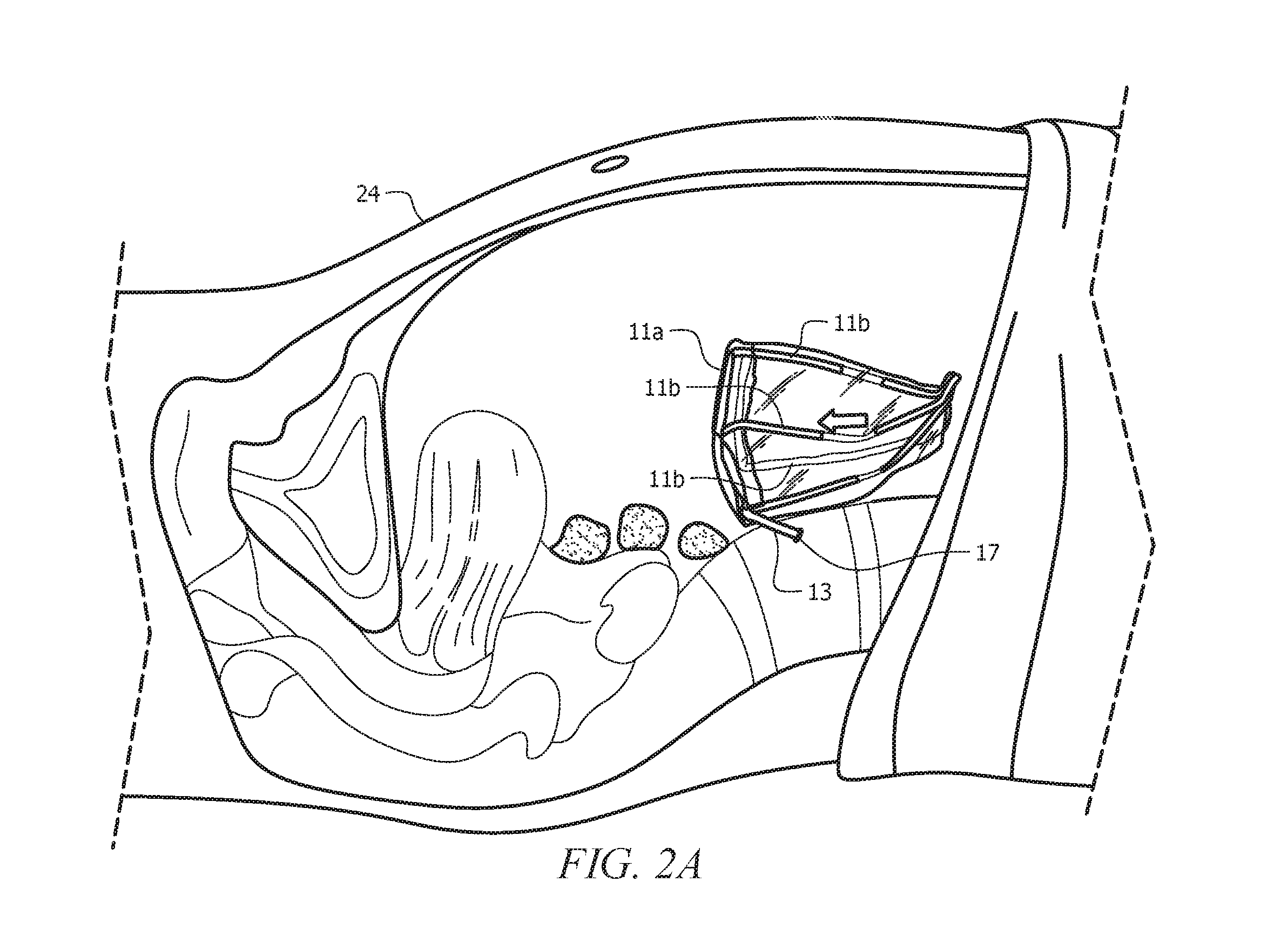 Pneumatic system and method for intermittently rigidifying an endoscopic specimen retaining carrier